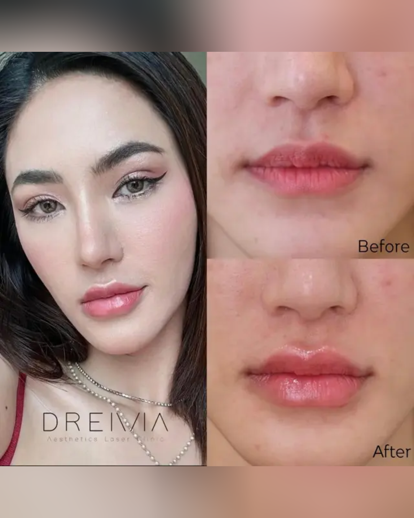 brush-teeth-after-having-lip-filler - Drema Clinic