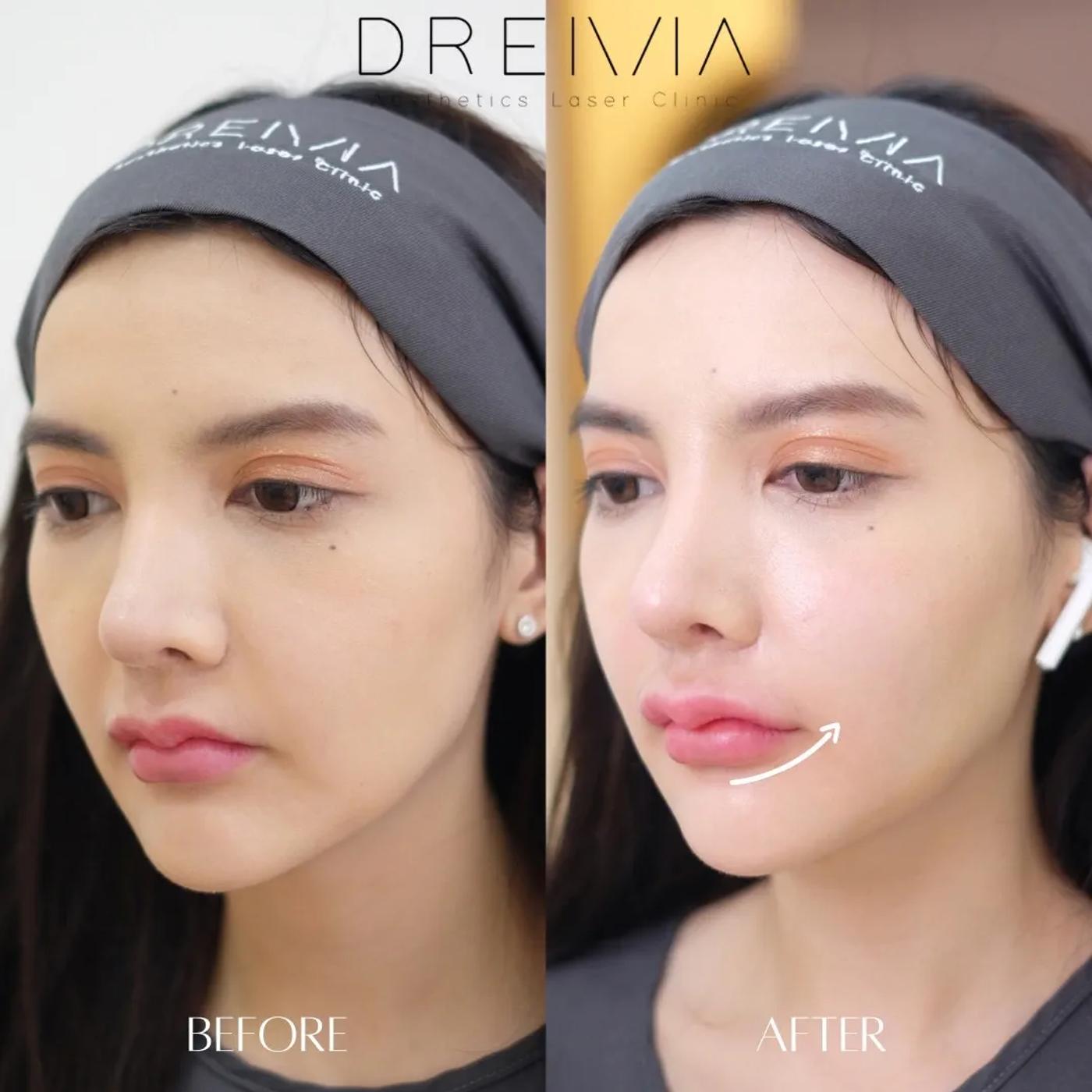 รีวิว Filler ปาก 17