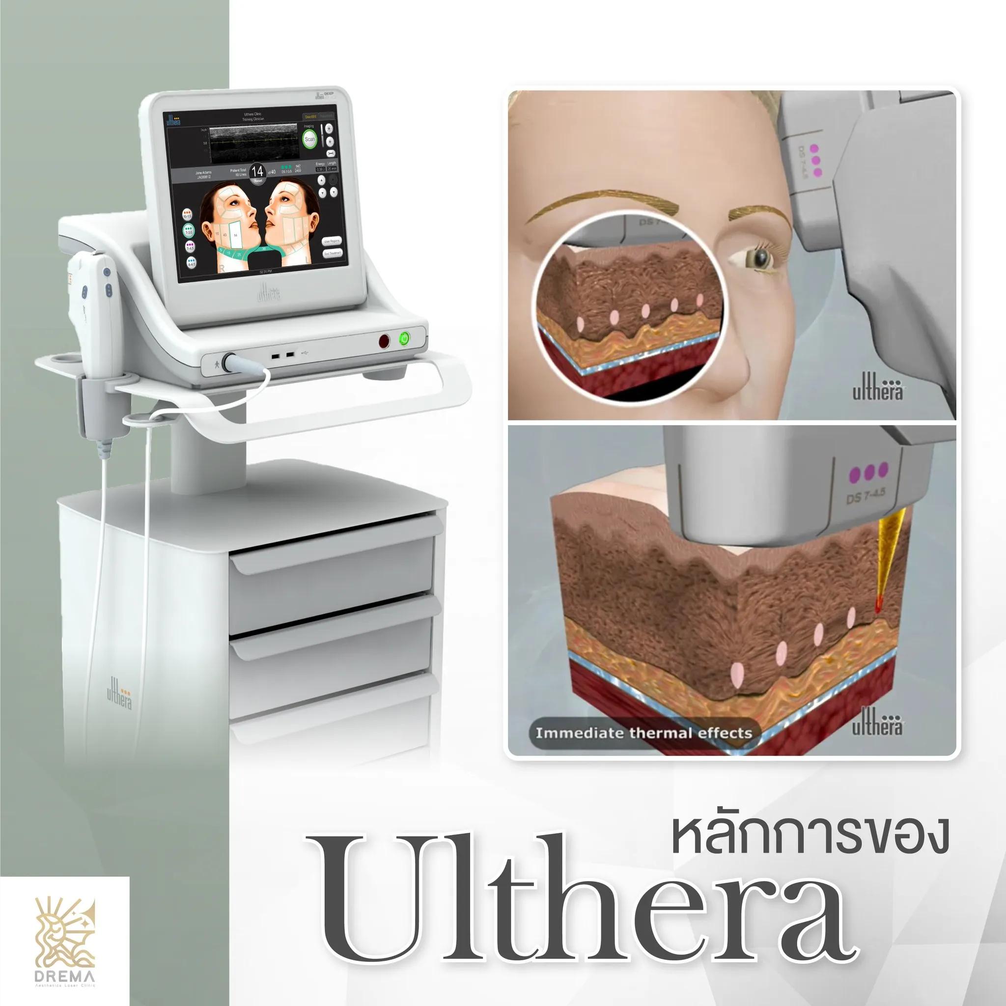 ไขคำตอบ Ulthera เจ็บไหม ระหว่างทำรู้สึกยังไง ดูแลตัวเองหลังทำยังไง