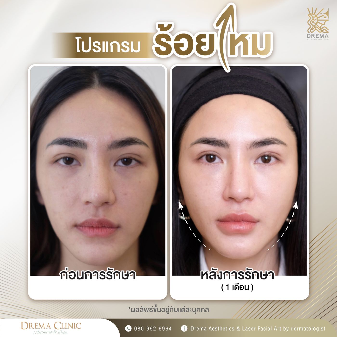 รูปรีวิว ร้อยไหม Drema Clinic เคสที่ 19
