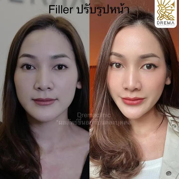 รีวิวการปรับรูปหน้า