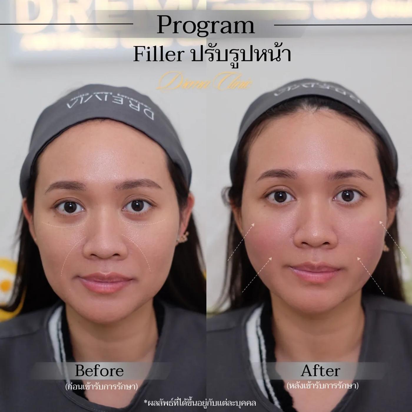 รีวิวการปรับรูปหน้า 23