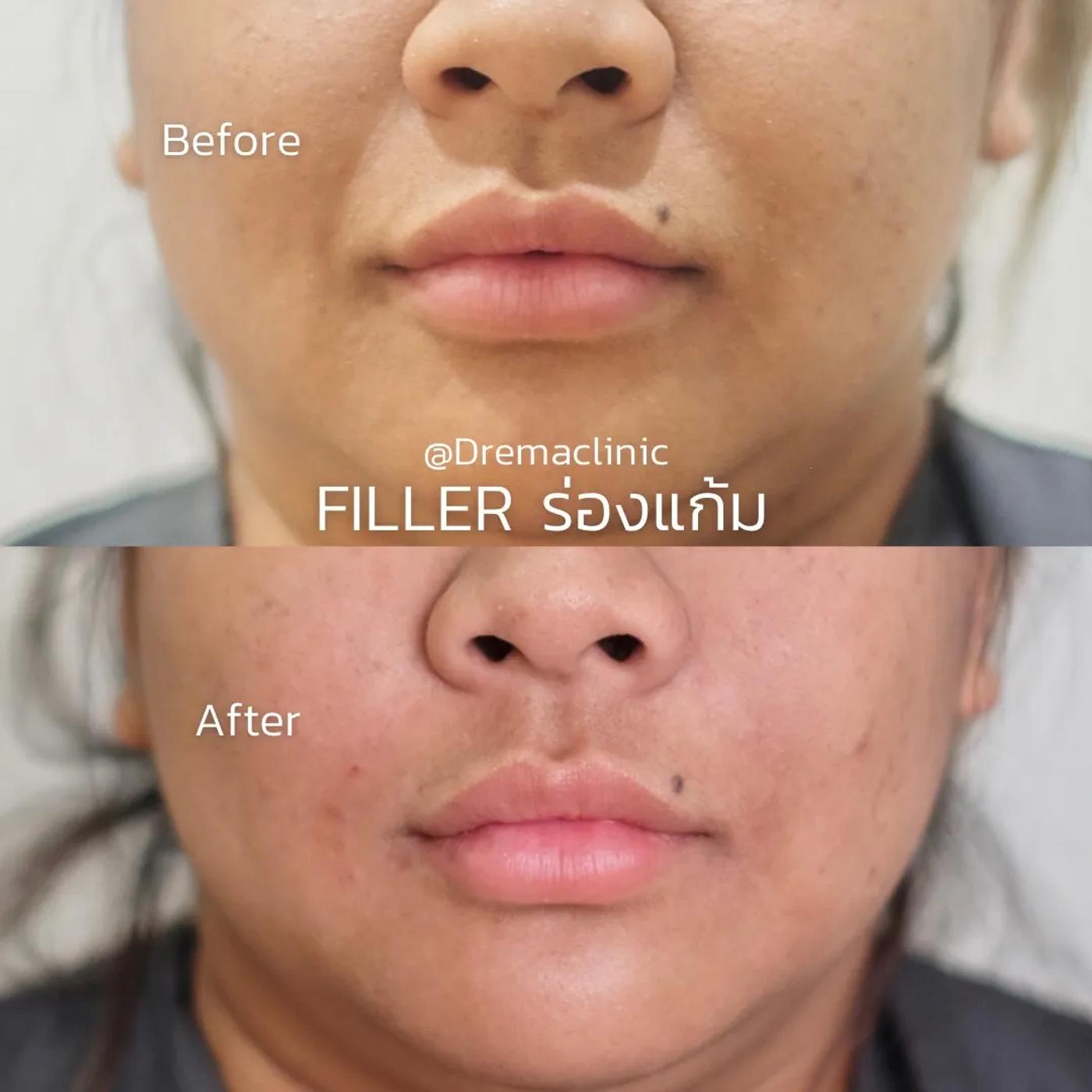 รีวิว Filler แก้มตอบ 8