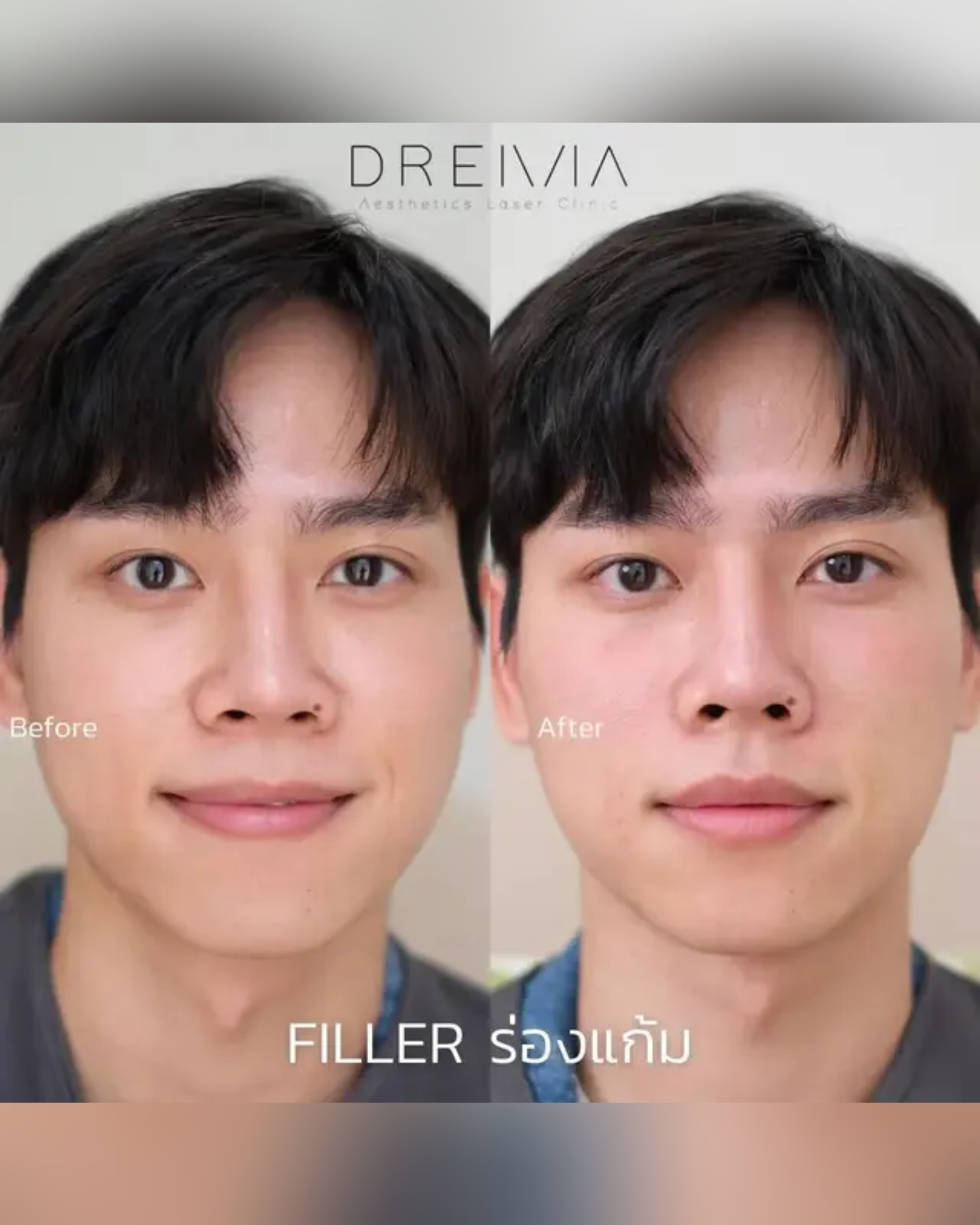 cheek-filler - Drema Clinic