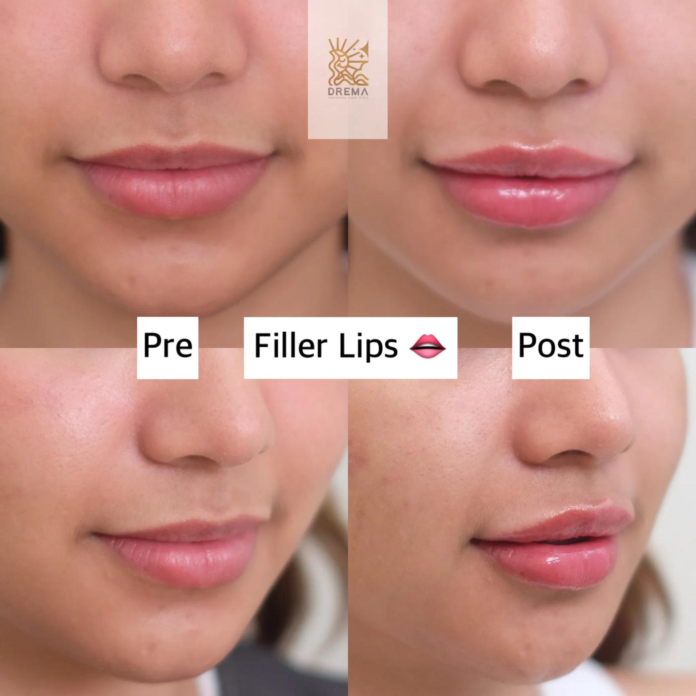 รีวิว Filler ปาก 29