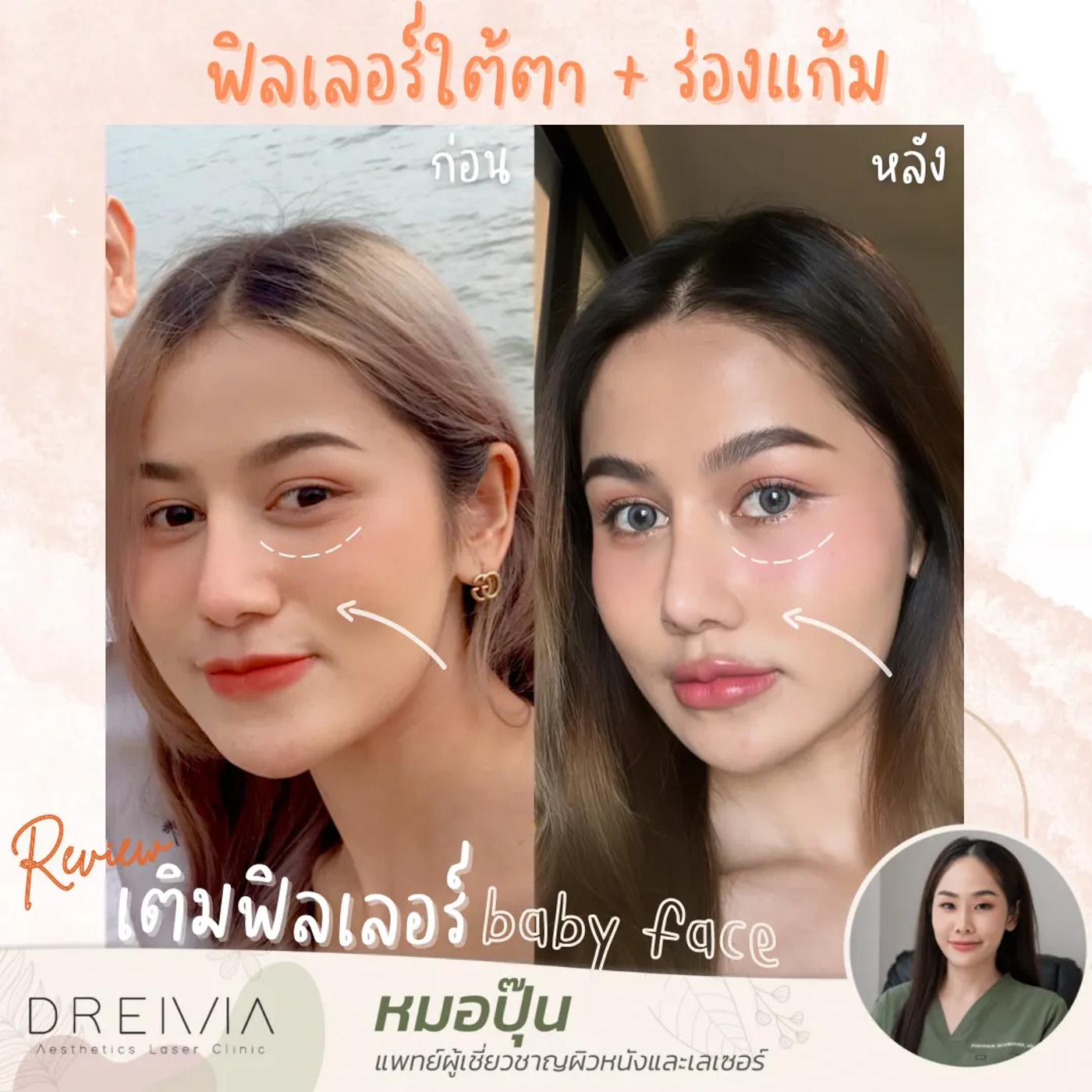 รีวิว Filler แก้มตอบ 2
