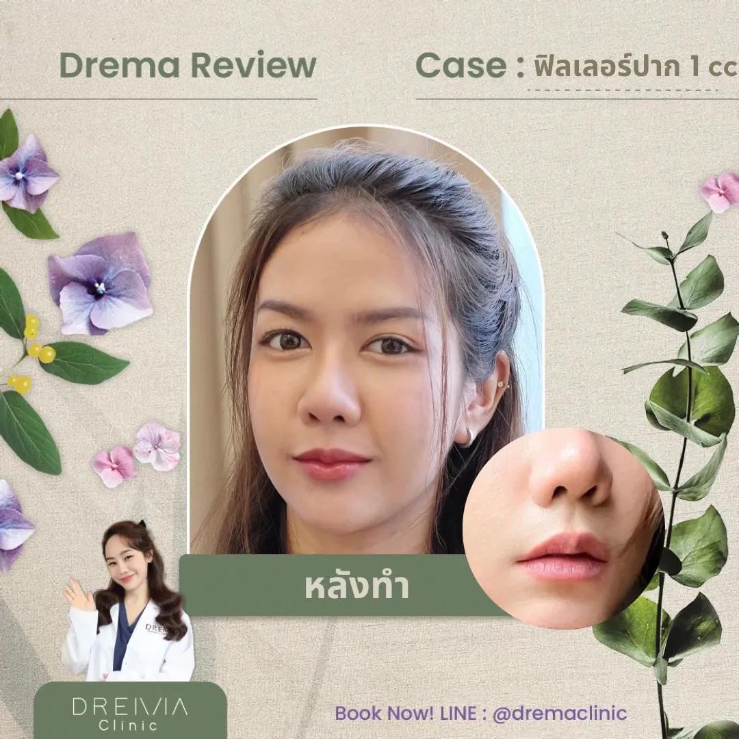 sexy-lip-filler-style-reviews - Drema Clinic