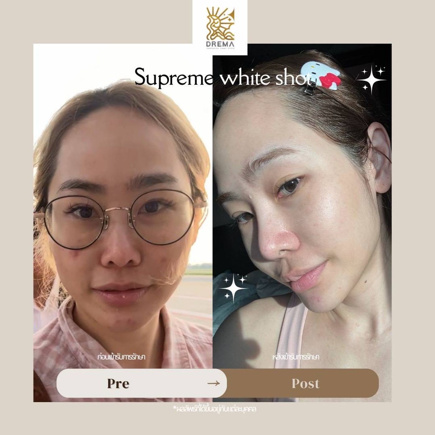 รูปรีวิว Skin Booster Drema Clinic เคสที่ 6