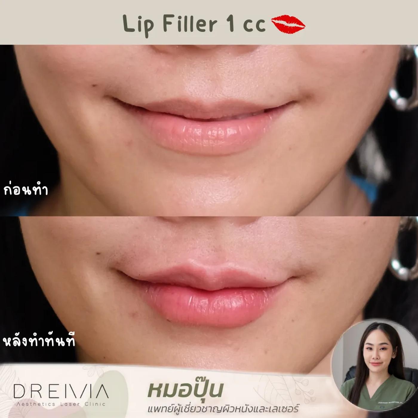 รีวิว Filler ปาก 3