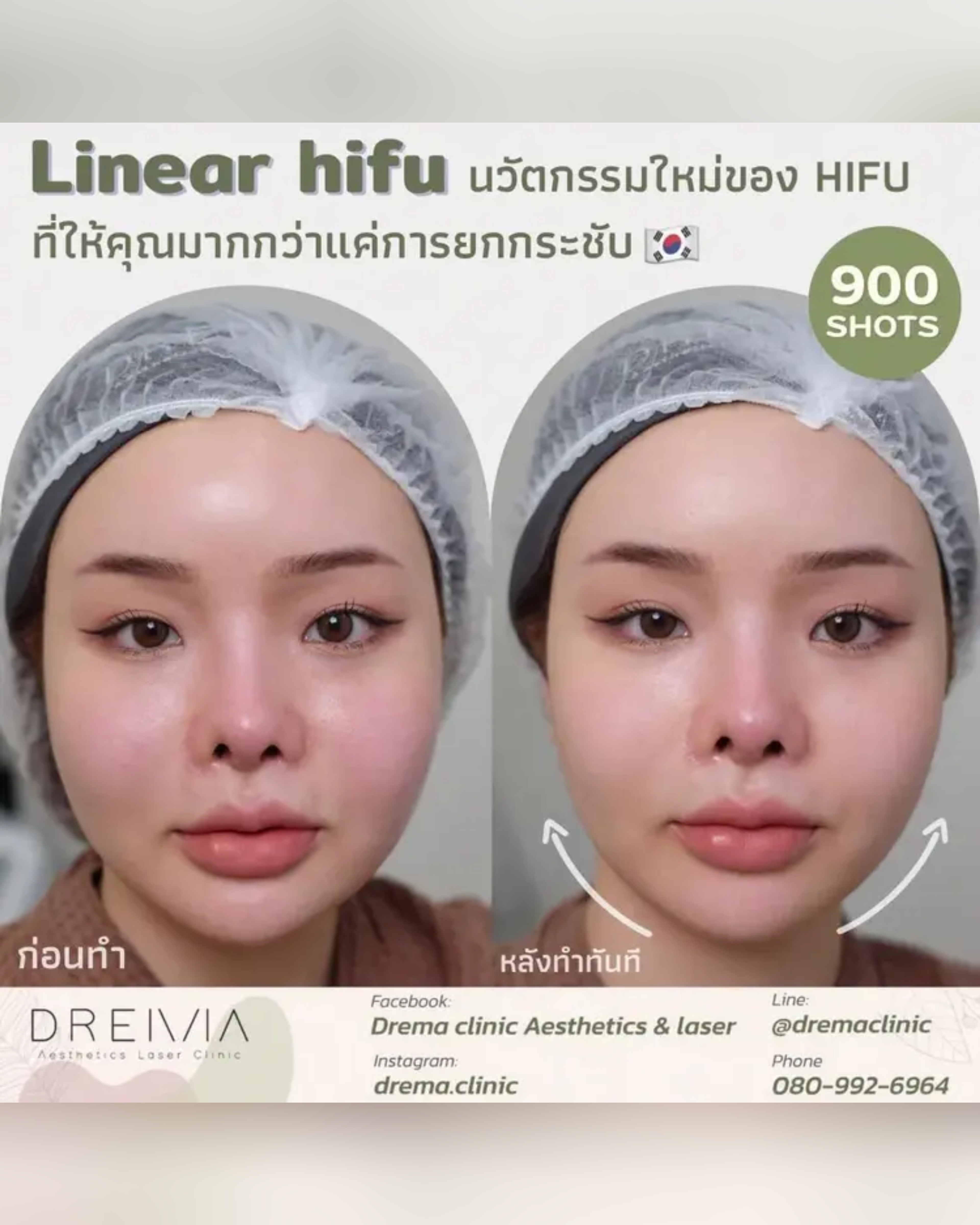 ตอบครบ แก้ปัญหาหน้าหย่นคล้อยด้วย ร้อยไหมกับไฮฟูอันไหนดีกว่ากัน - Drema Clinic