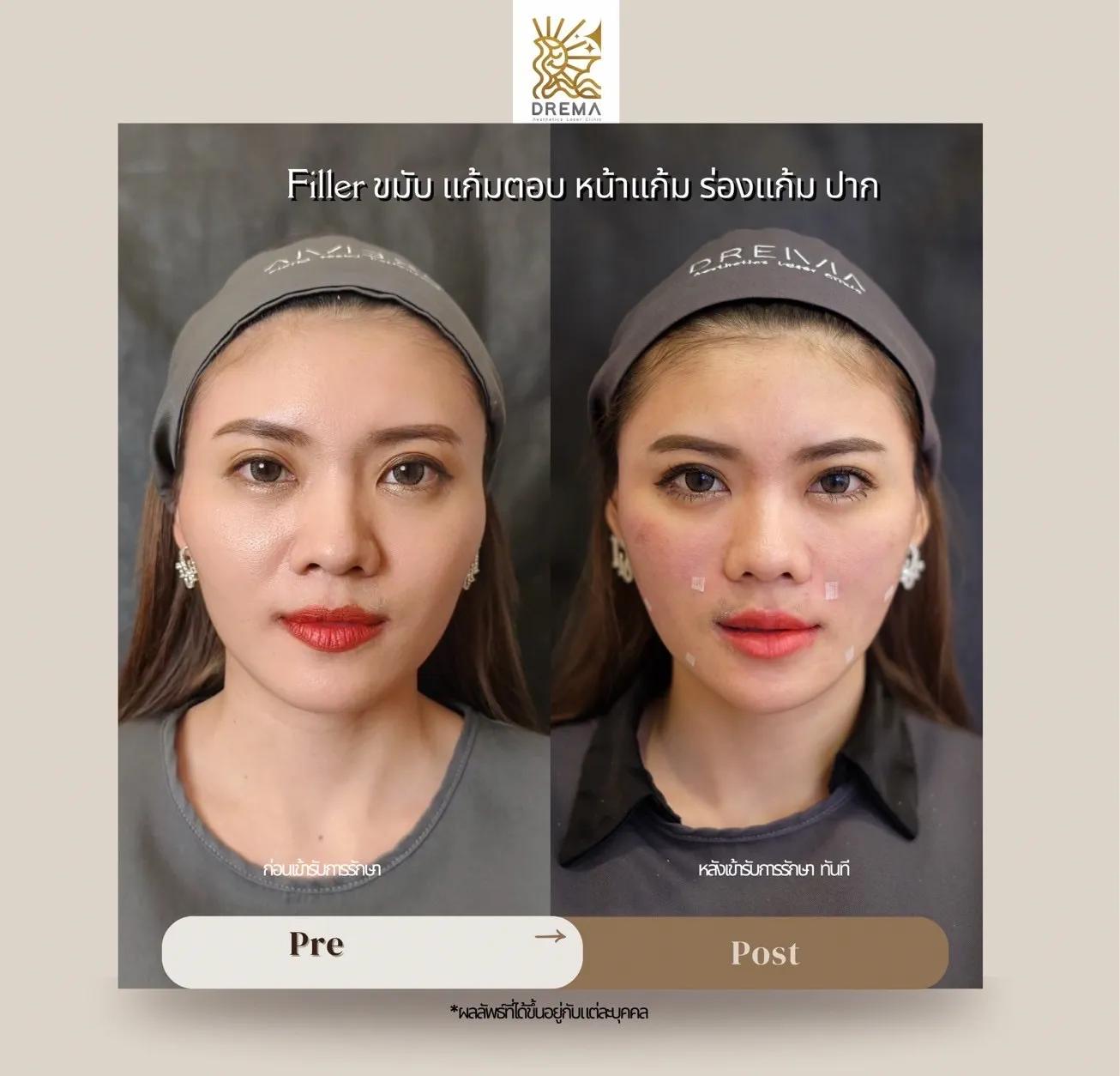 sunken-cheek-filler - Drema Clinic
