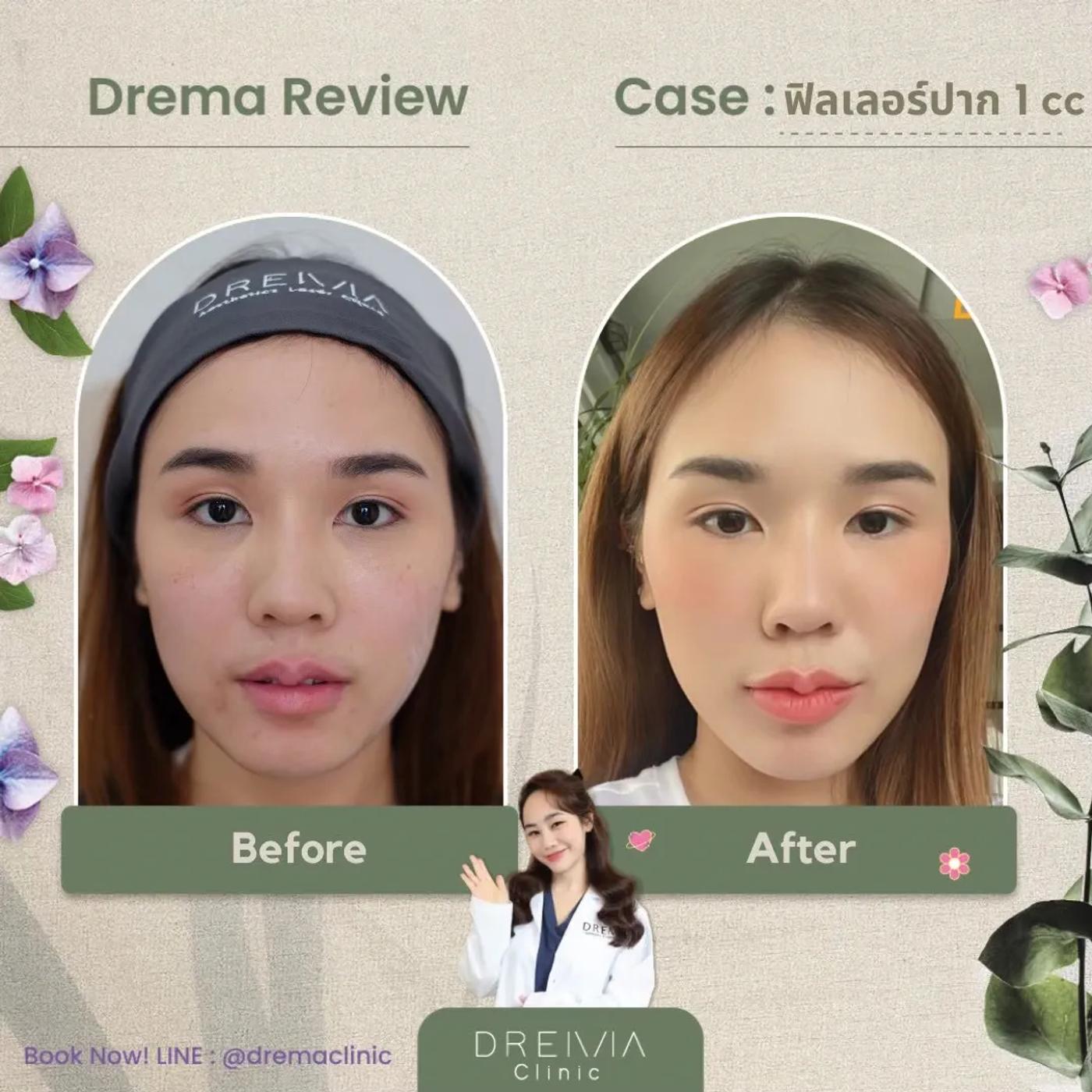 รีวิว Filler ปาก 23