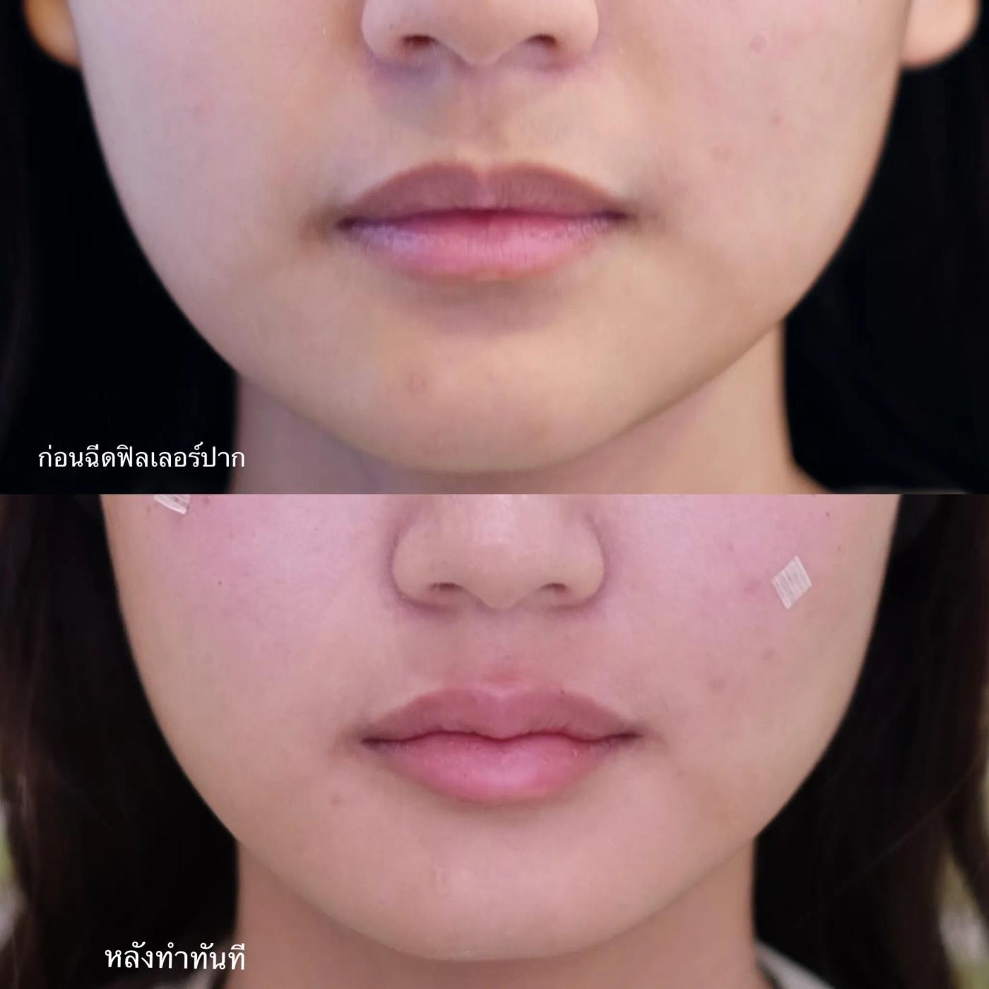 รีวิว Filler ปาก 35