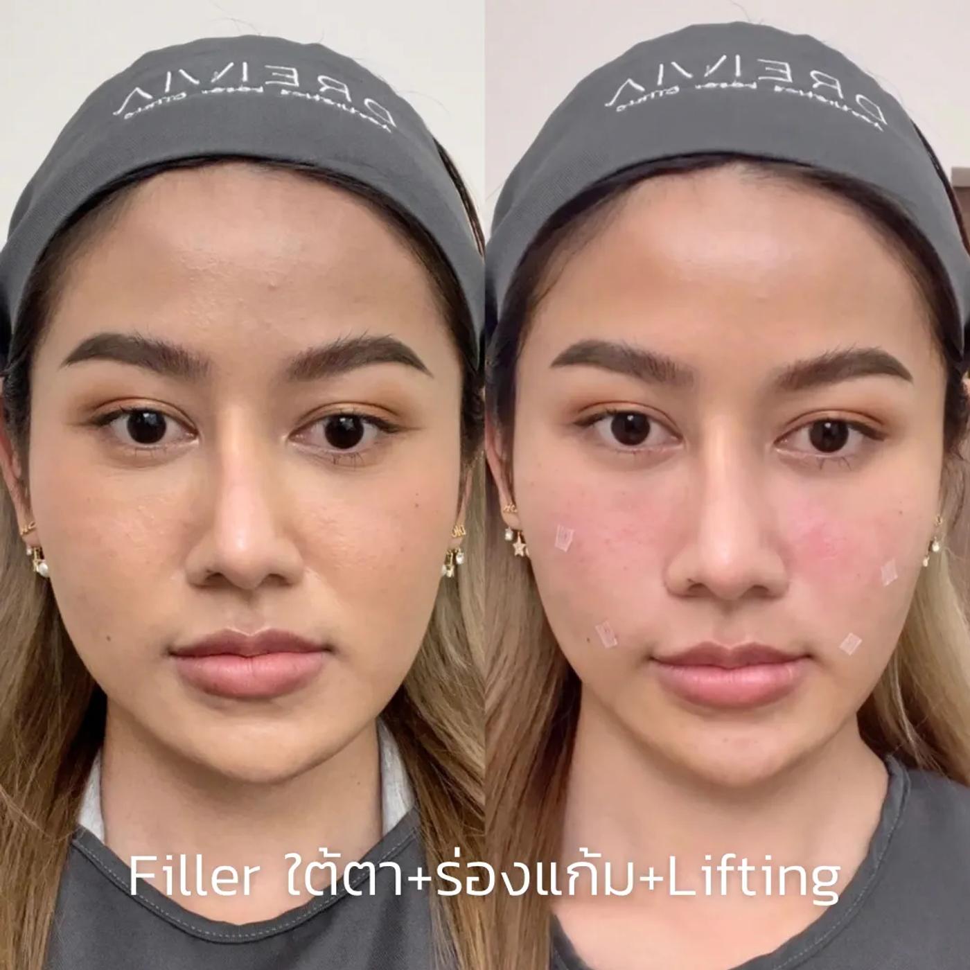 รีวิว Filler แก้มตอบ 9