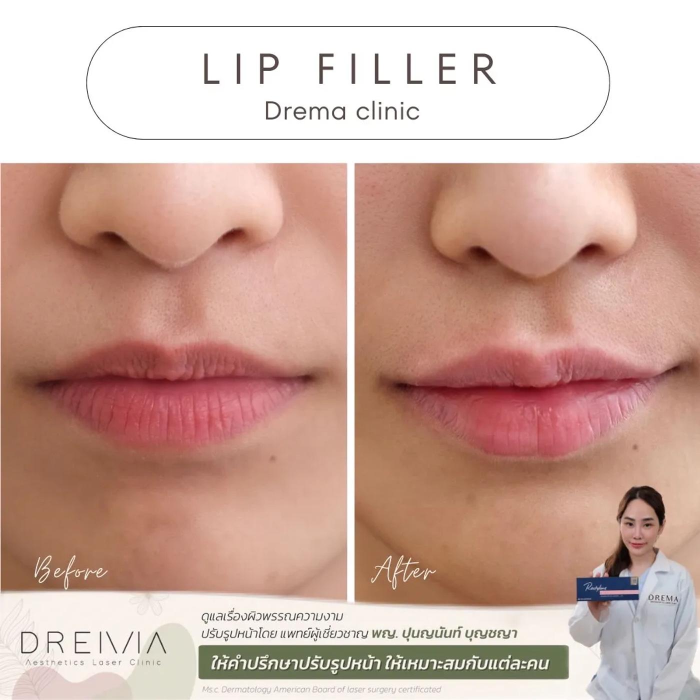 รีวิว Filler ปาก 18
