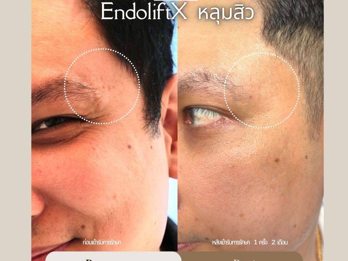 รีวิว Endolift Drema Clinic