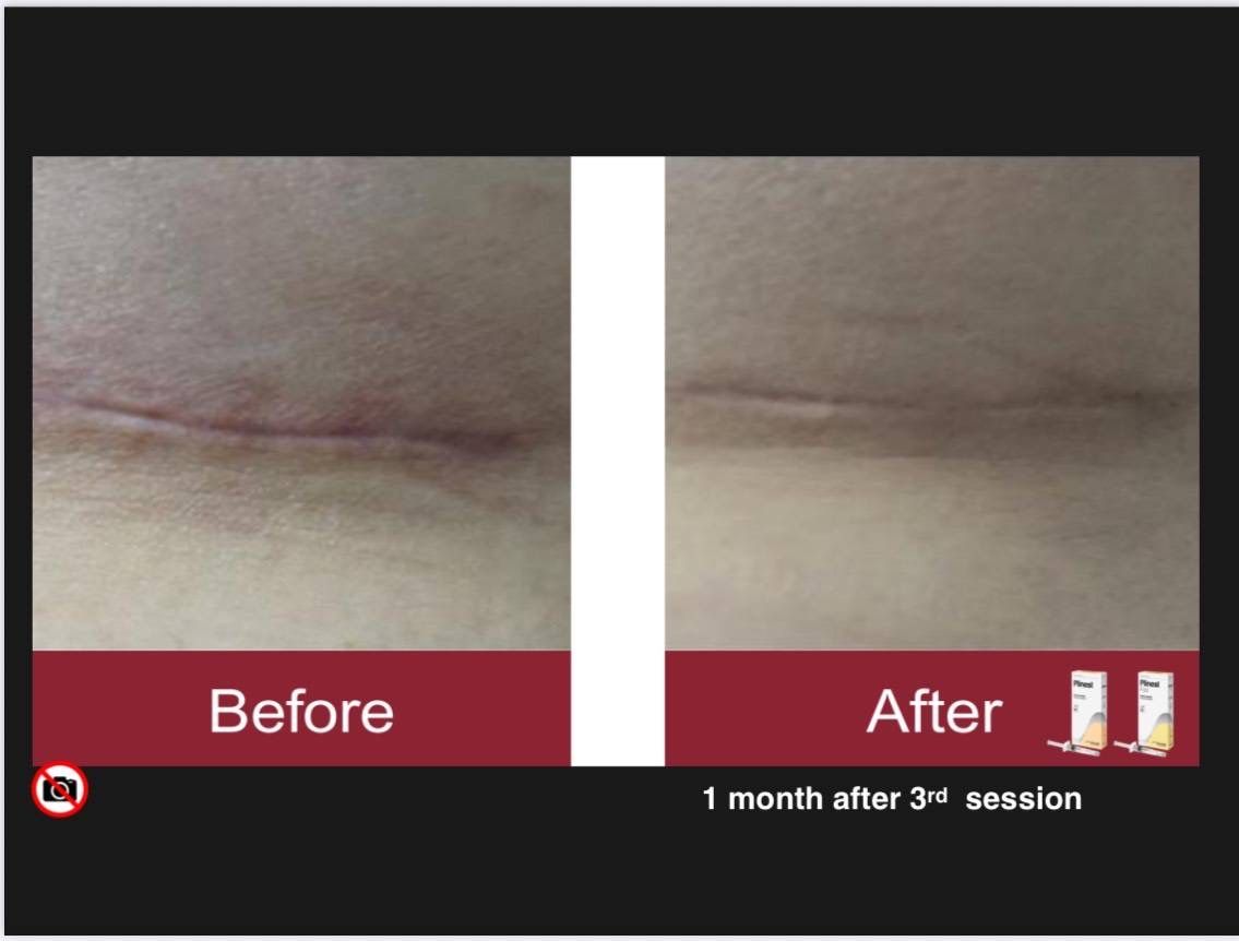 รูปรีวิว Skin Booster Drema Clinic เคสที่ 17