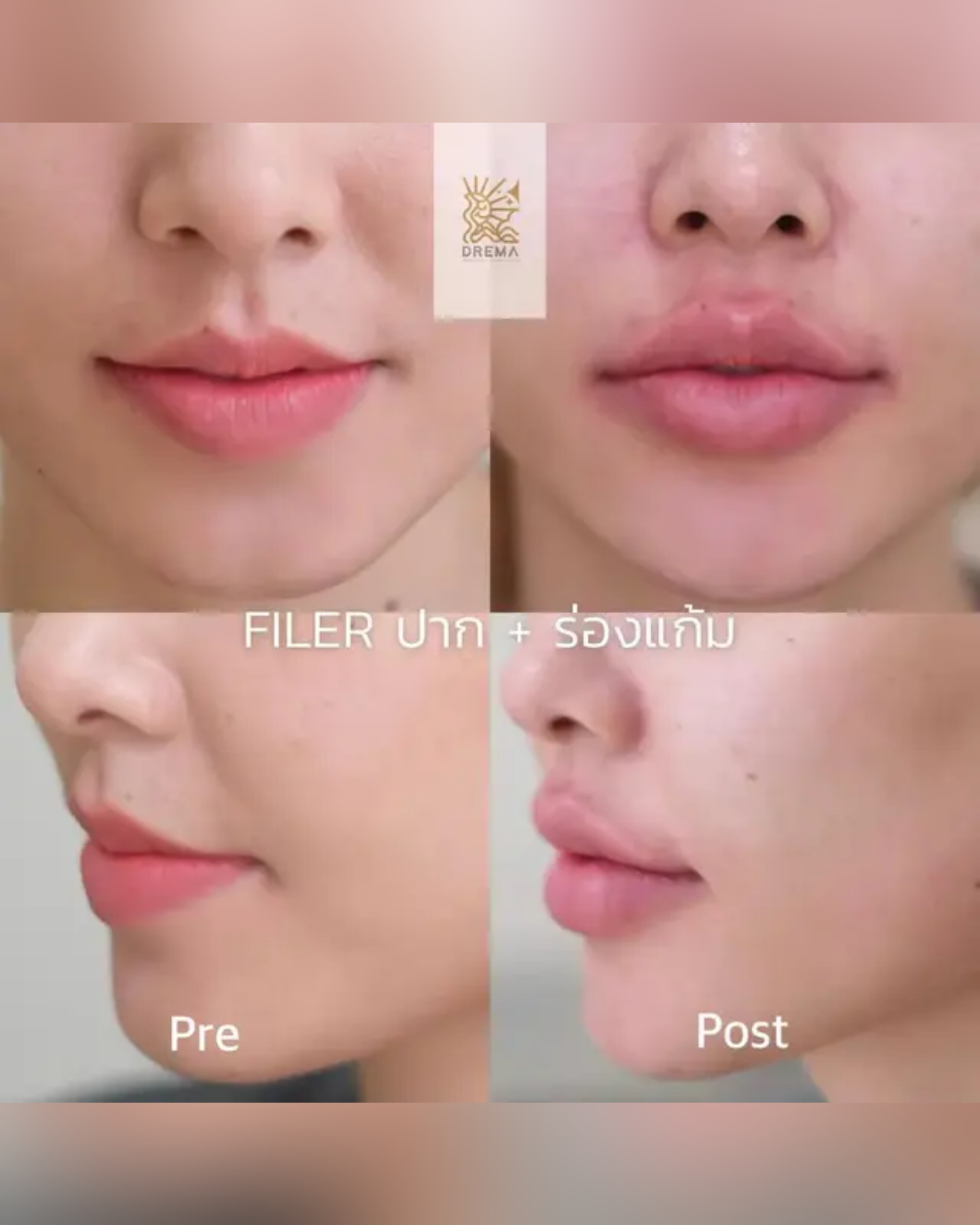 how-long-lip-filler-lasts - Drema Clinic
