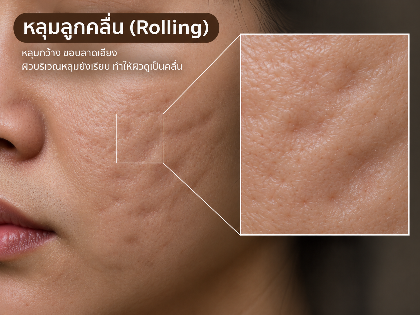 หลุมสิว