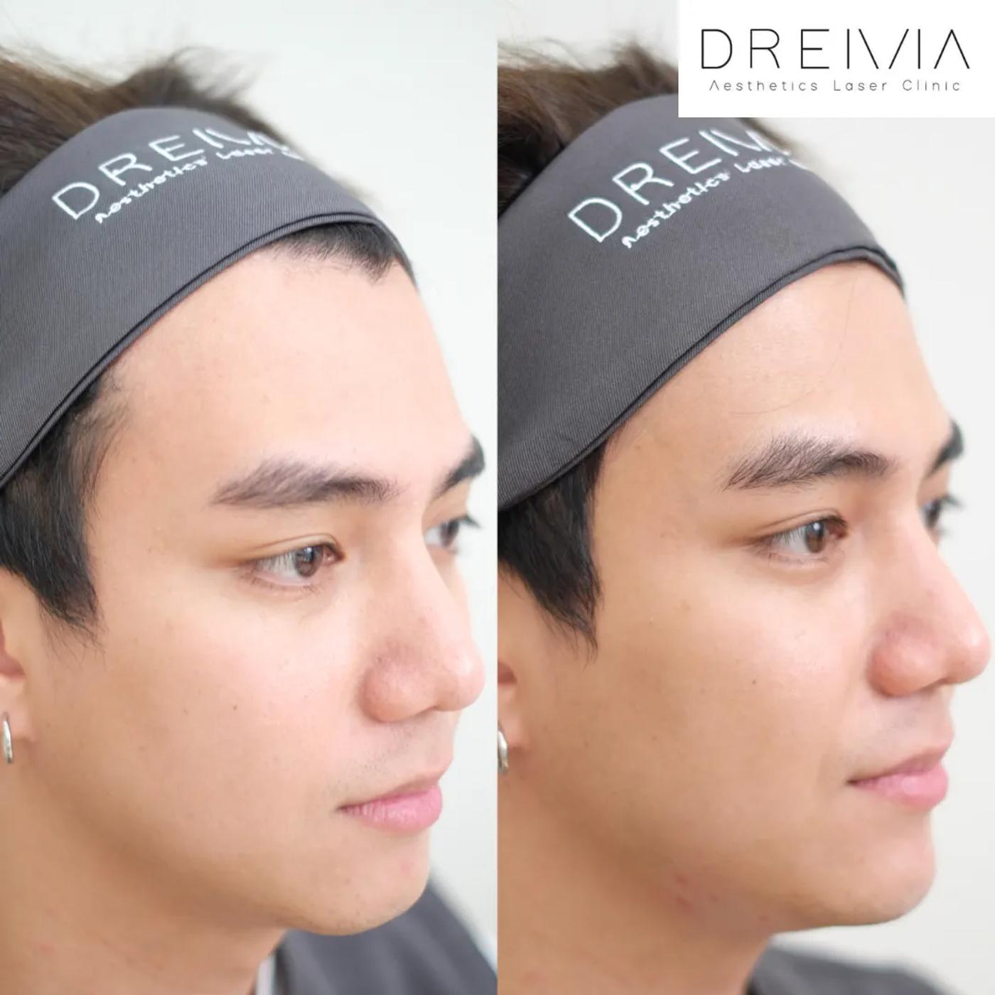 รีวิว ฟิลเลอร์คาง 10