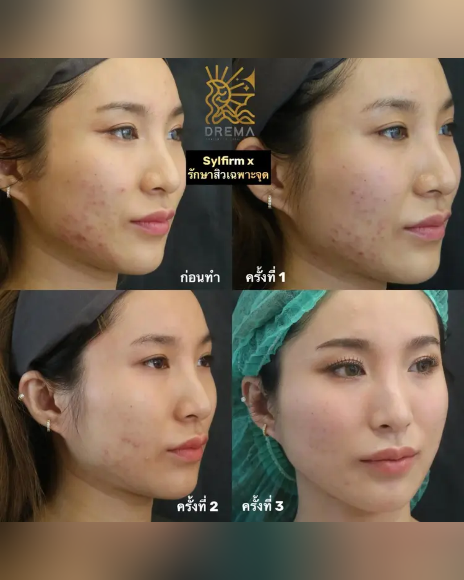 Sylfirm X ตัวช่วยจบปัญหาหลุมสิว ฝ้า รูขุมขน เผยผิวเรียบเนียนดูอ่อนเยาว์