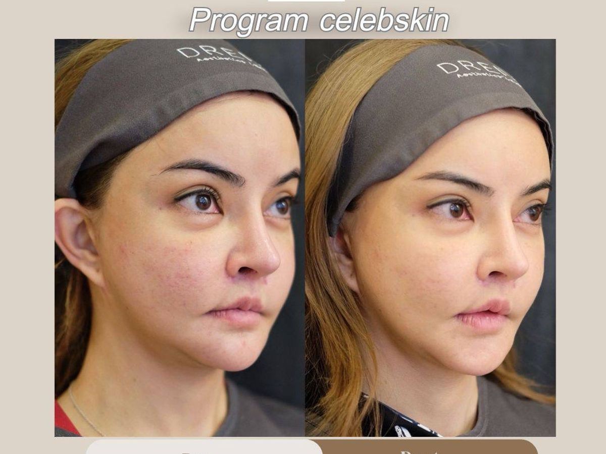 รูปรีวิว Skin Booster Drema Clinic เคสที่ 1