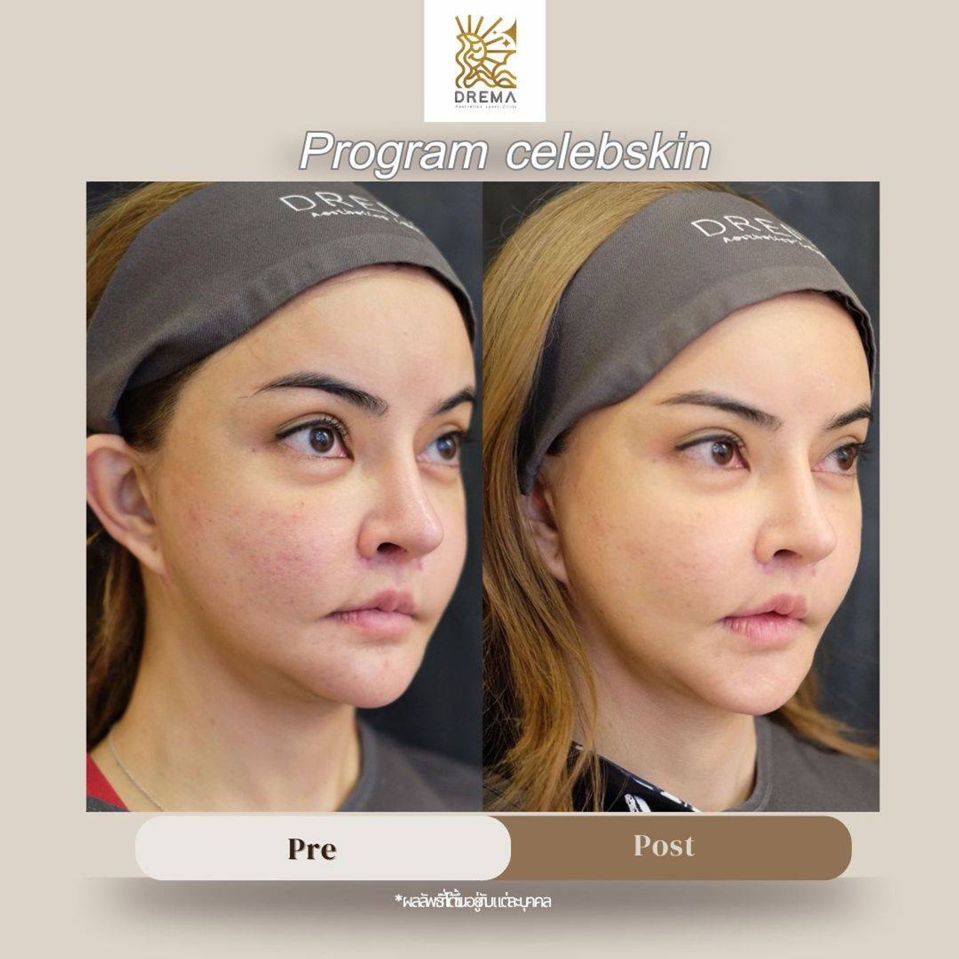 รูปรีวิว Skin Booster Drema Clinic เคสที่ 1