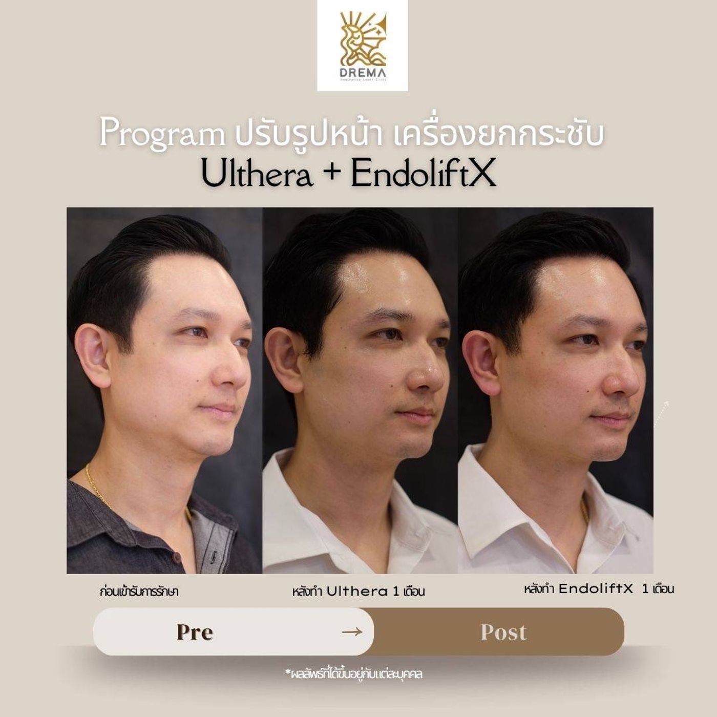 รูปรีวิว Endolift Drema Clinic เคสที่ 6