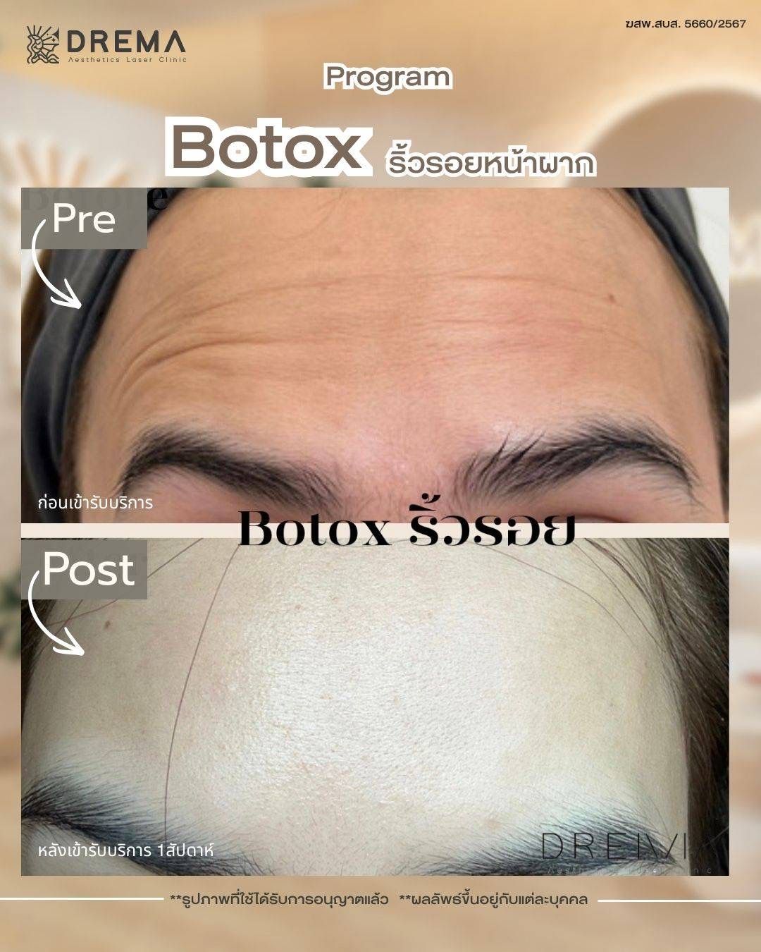 รูปรีวิว Botox Drema Clinic เคสที่ 6