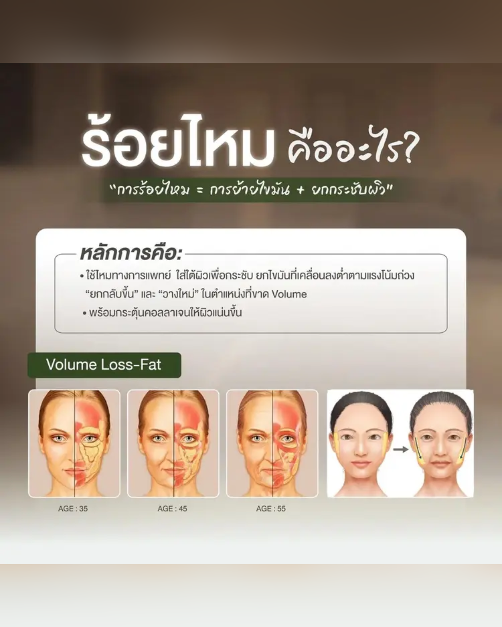 ยกกระชับใบหน้าให้เรียวสวย ด้วยการร้อยไหม (Thread Lifting) - Drema Clinic