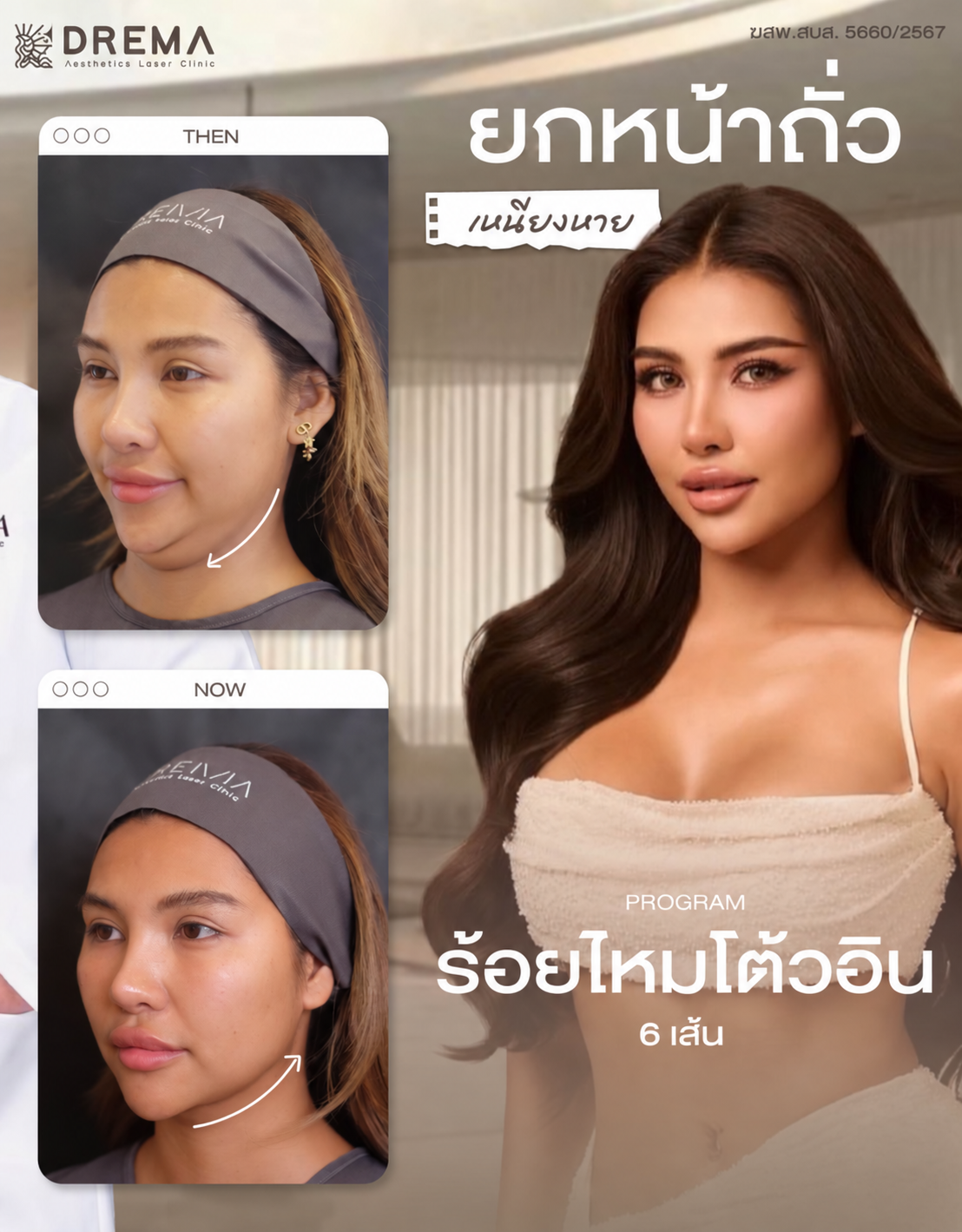 ร้อยไหม