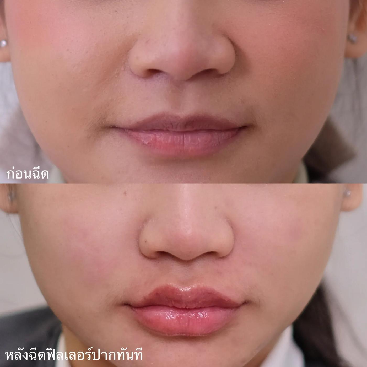 รีวิว Filler ปาก 31
