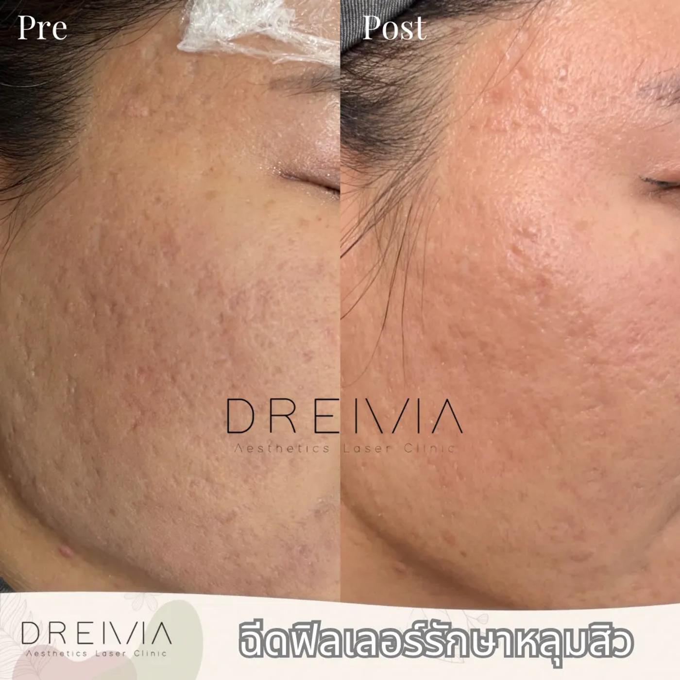 รีวิว SYLFIRM X 6