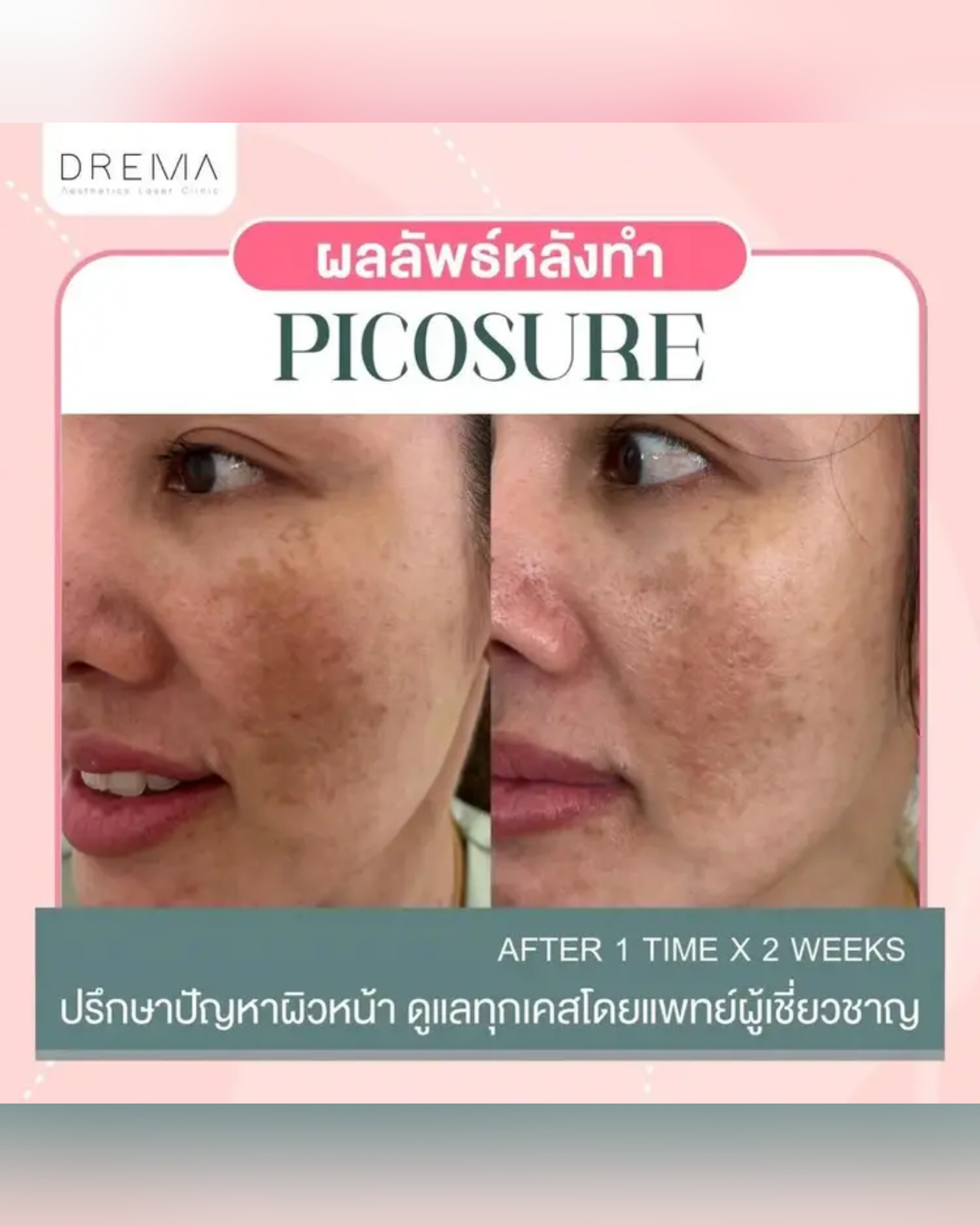 เทียบชัด ๆ Picosecond Laser กับ Picosure ต่างกันอย่างไร เลือกแบบไหนดี