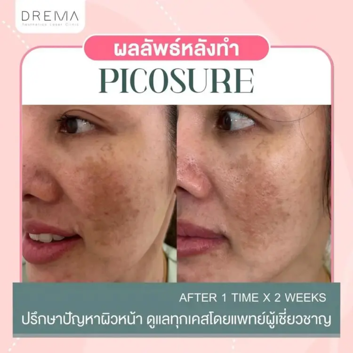 เทียบชัด ๆ Picosecond Laser กับ Picosure ต่างกันอย่างไร เลือกแบบไหนดี