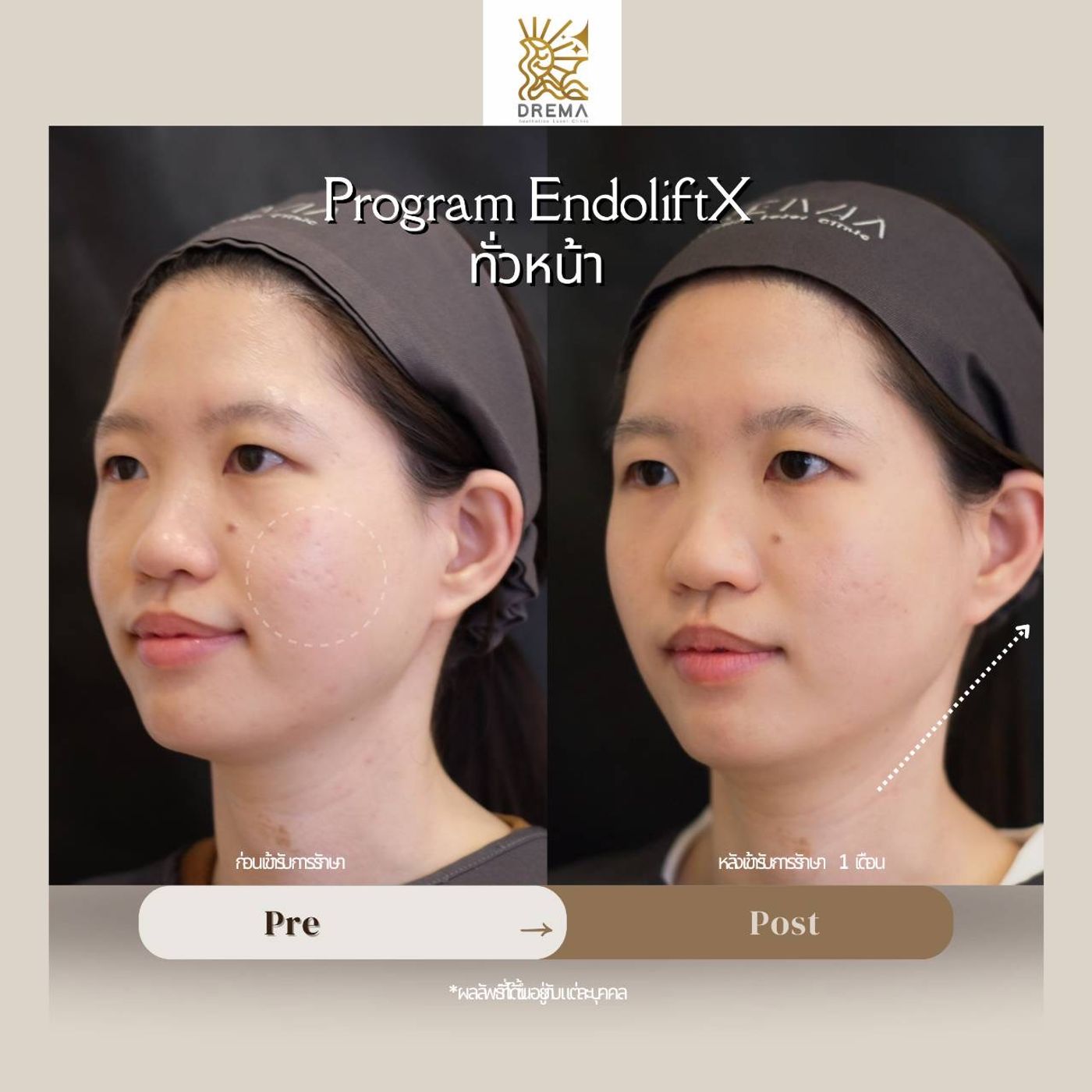 รูปรีวิว Endolift Drema Clinic เคสที่ 13