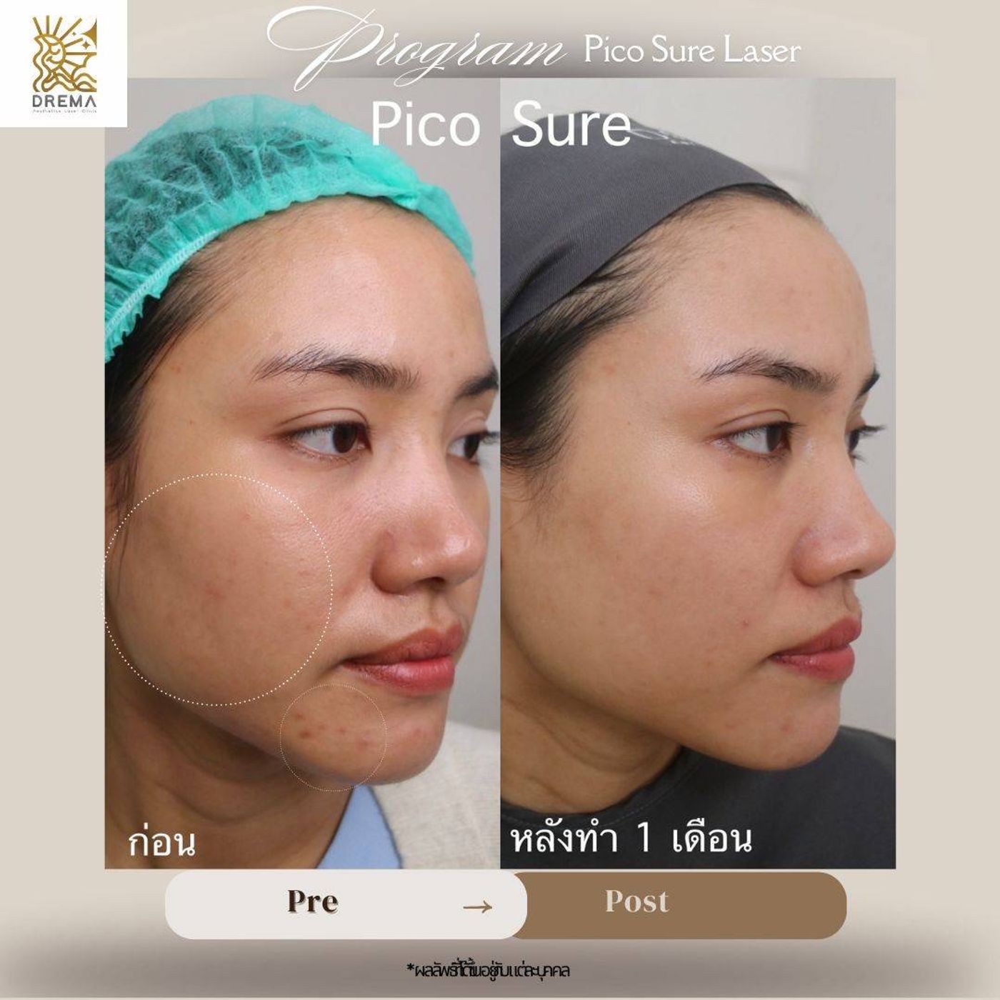 รูปรีวิว Pico Drema Clinic เคสที่ 7