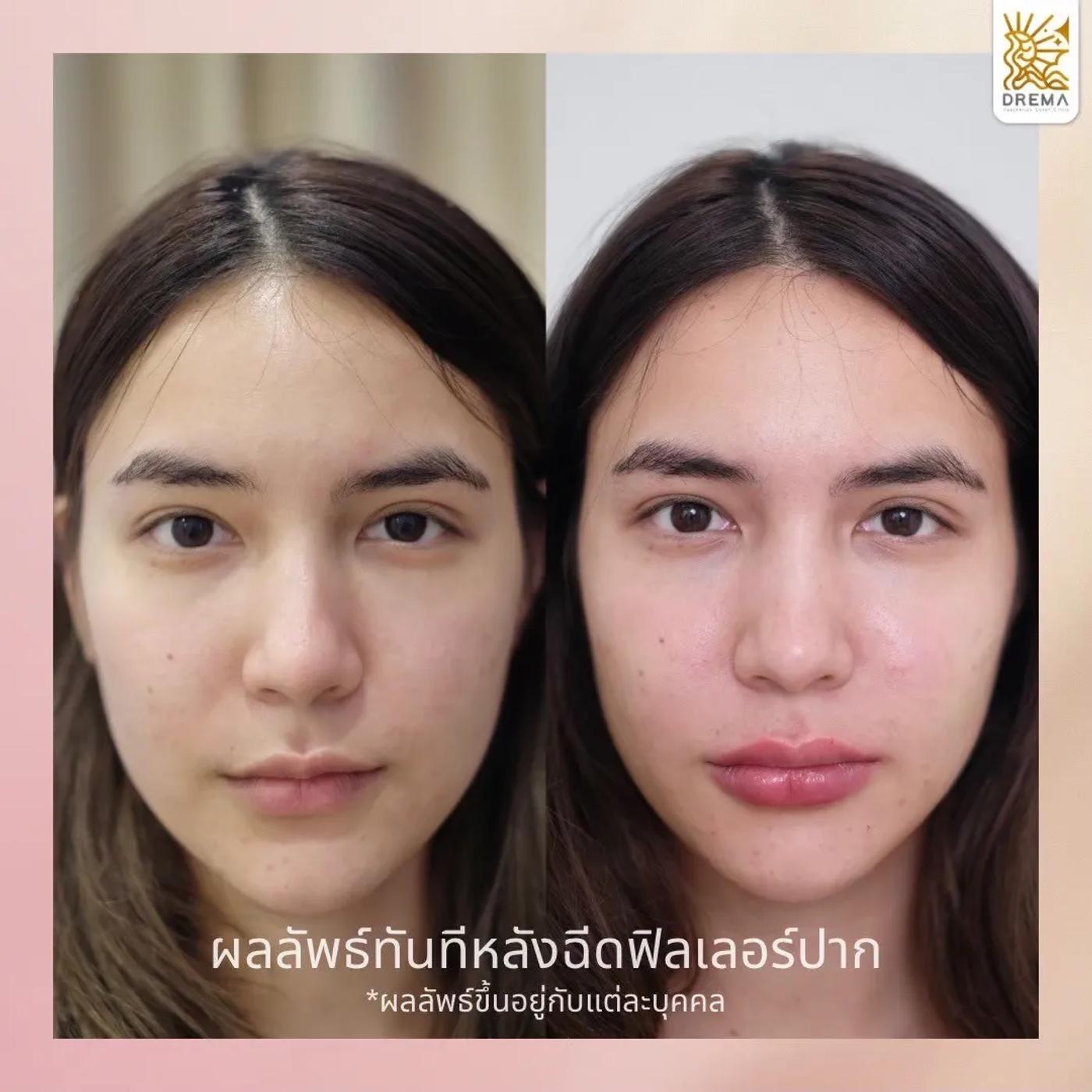 รีวิว Filler ปาก 8