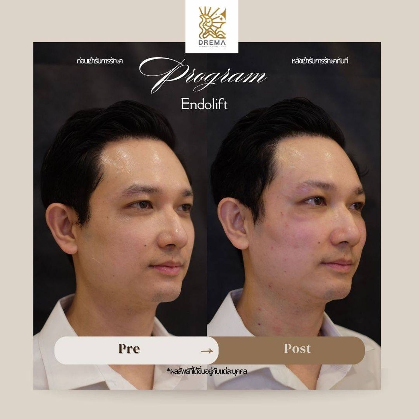 รูปรีวิว Ulthera Drema Clinic เคสที่ 6