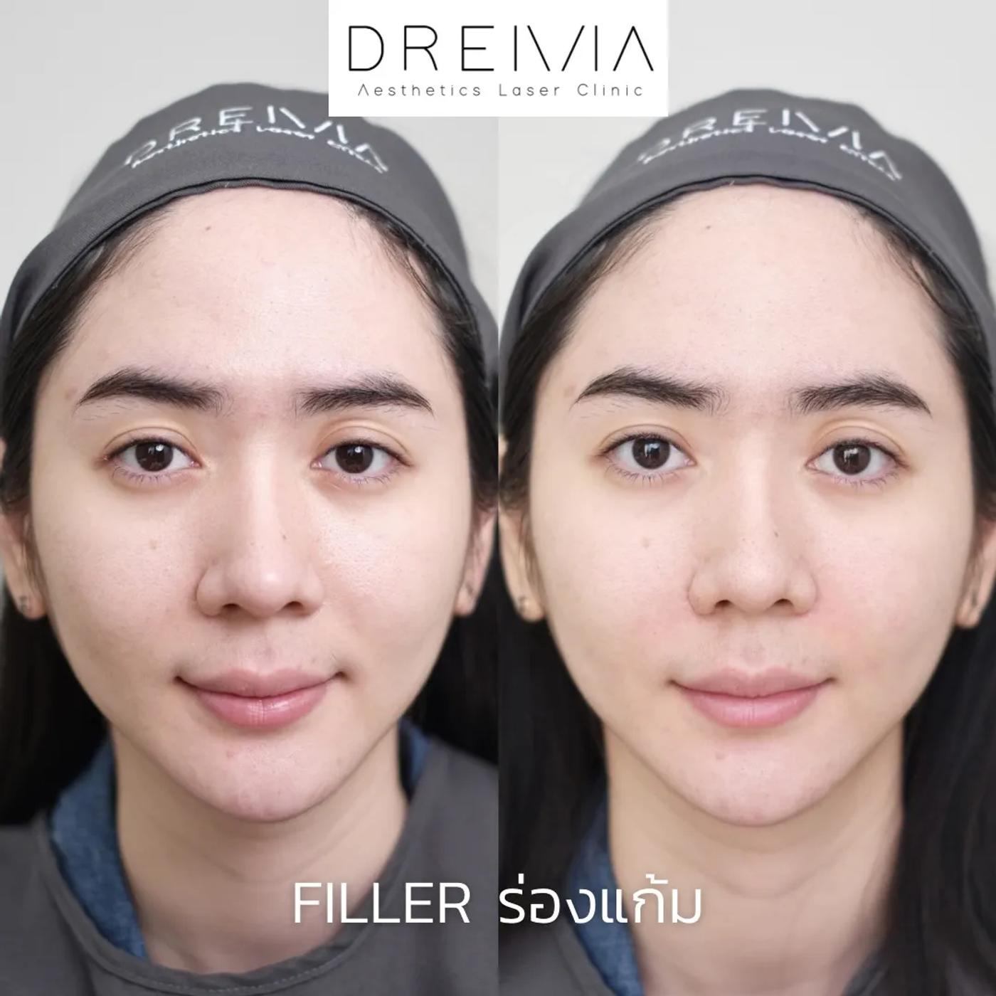 รีวิว Filler แก้มตอบ 4