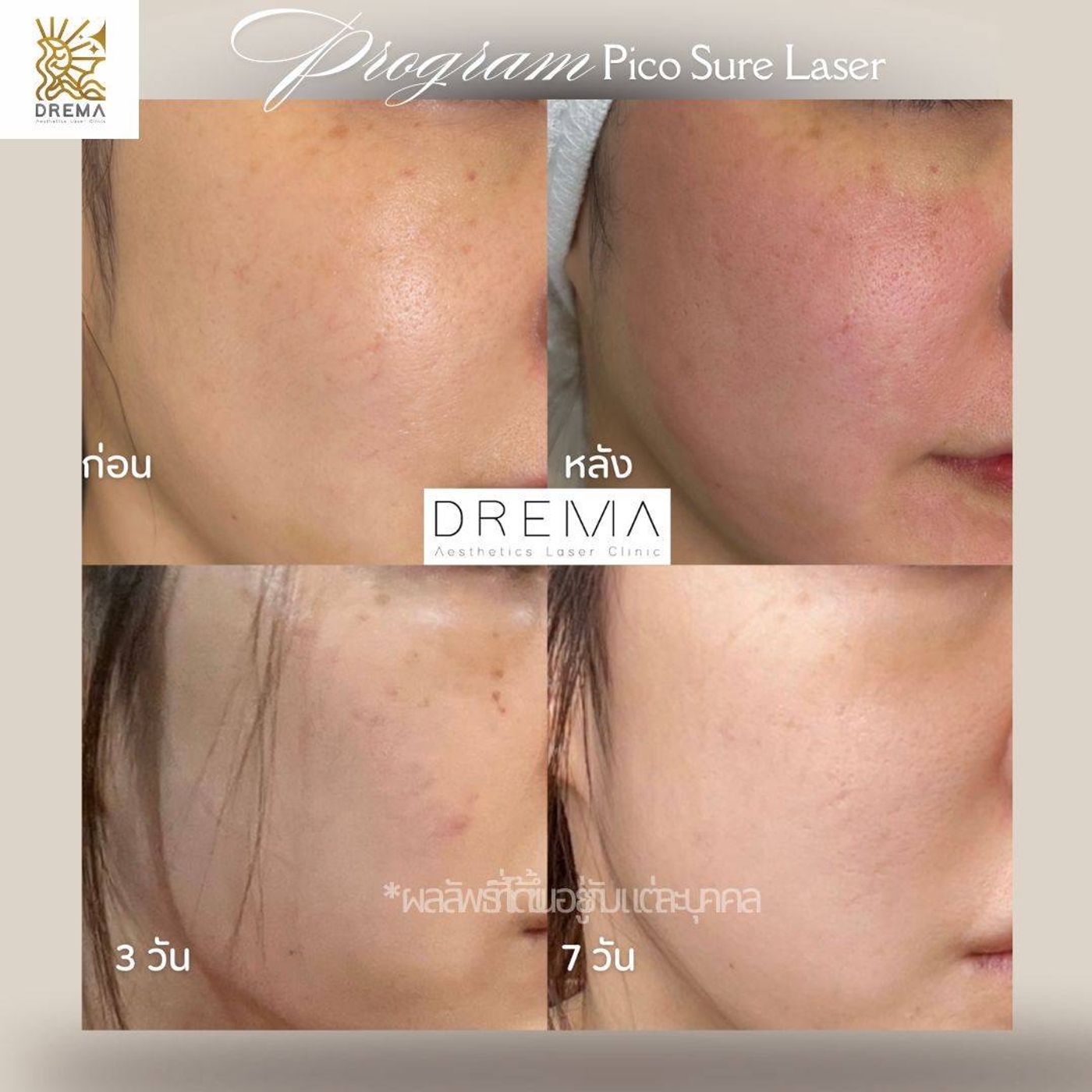 รูปรีวิว Pico Drema Clinic เคสที่ 13
