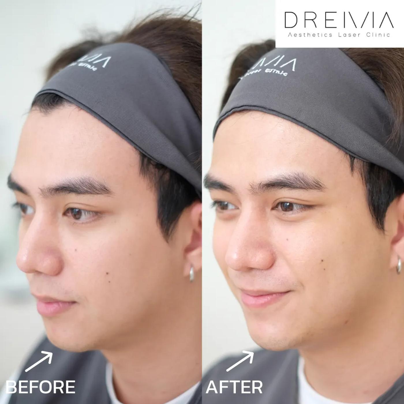 รีวิว ฟิลเลอร์คาง 9