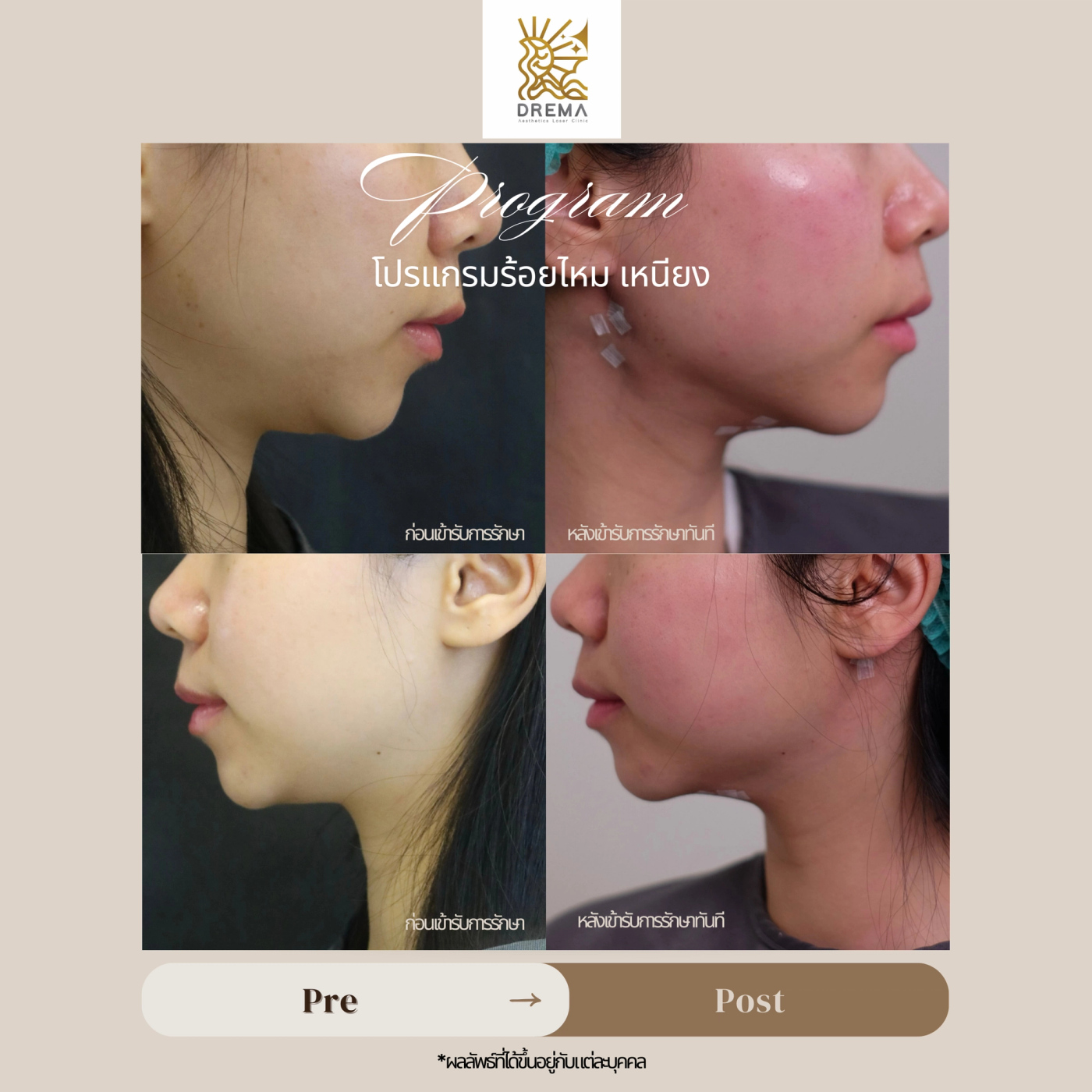 รูปรีวิว ร้อยไหม Drema Clinic เคสที่ 30