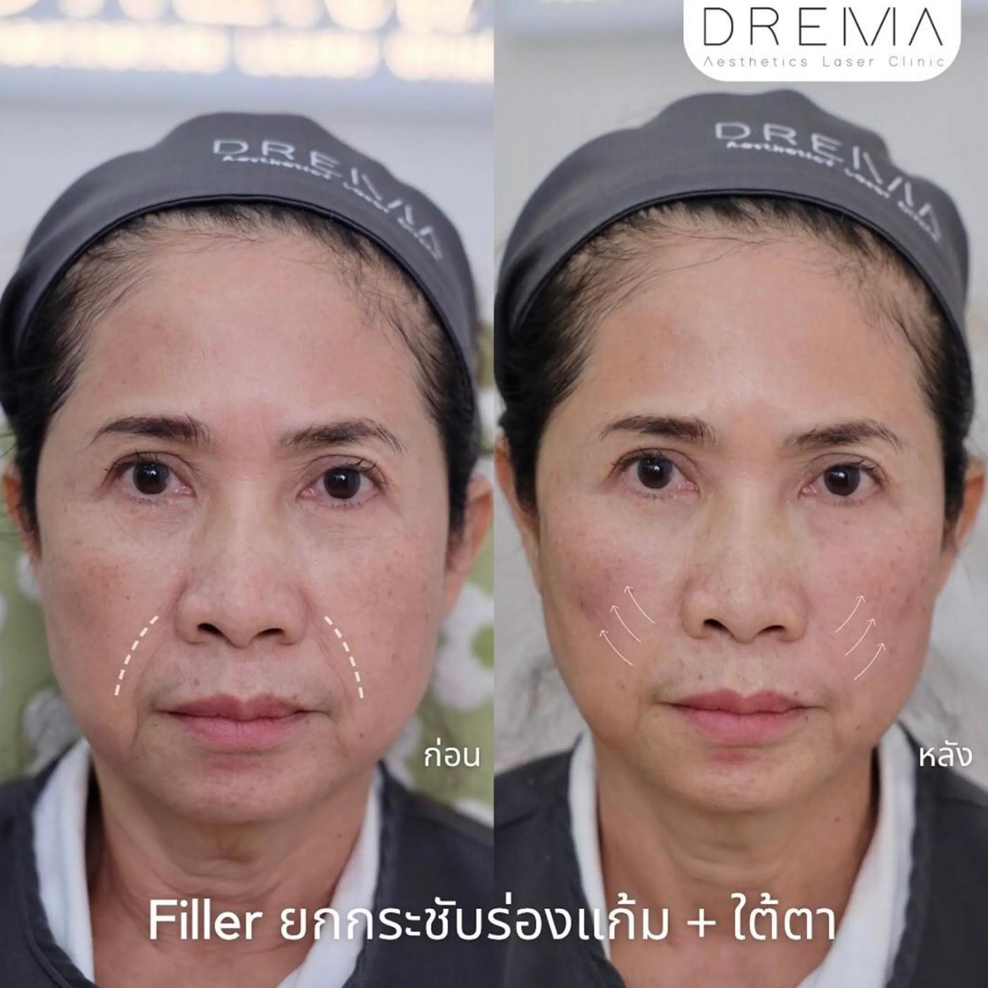 รีวิว Filler แก้มตอบ 1