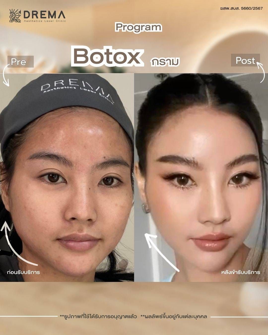 รูปรีวิว Botox Drema Clinic เคสที่ 4