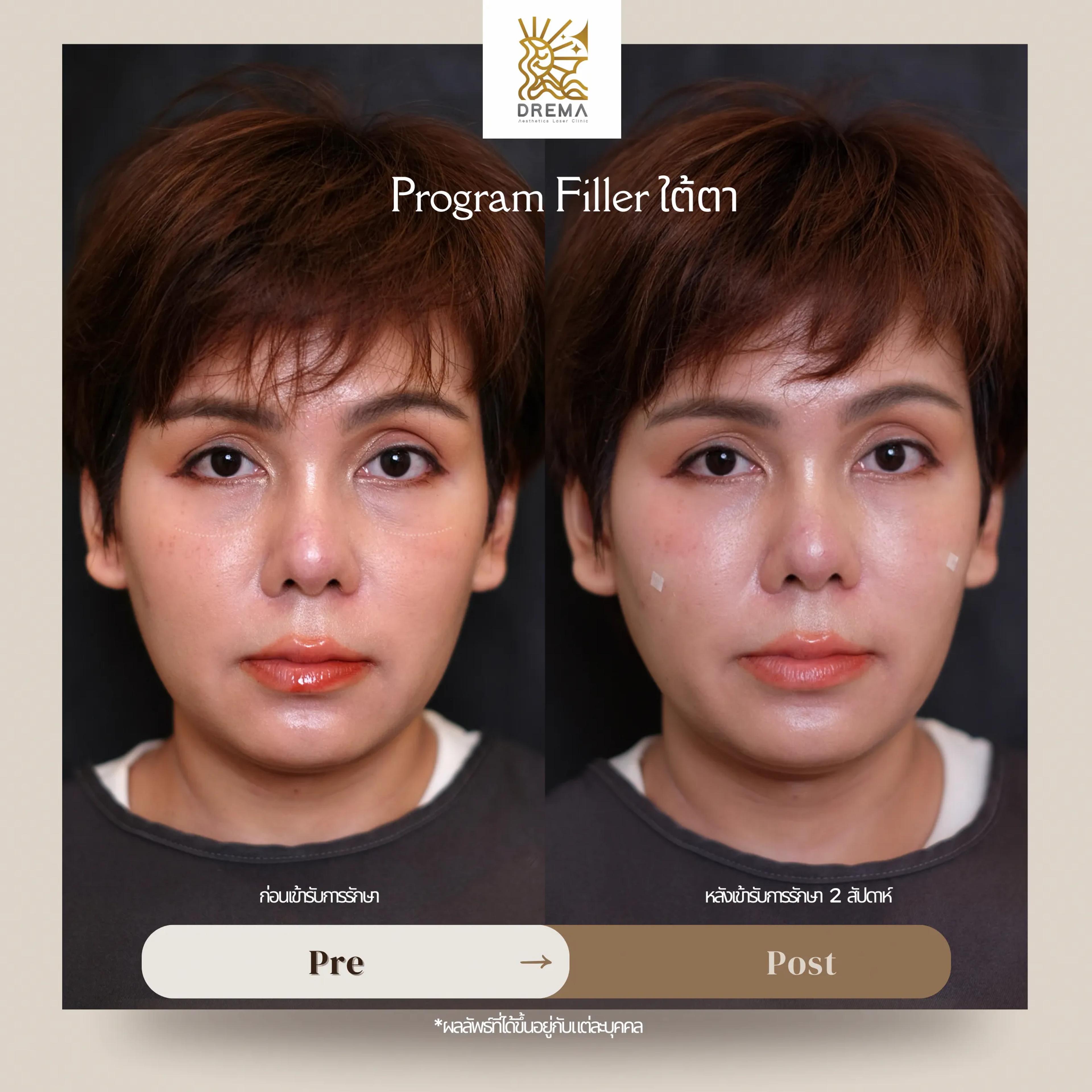 under-eye-filler-risks-complications - Drema Clinic