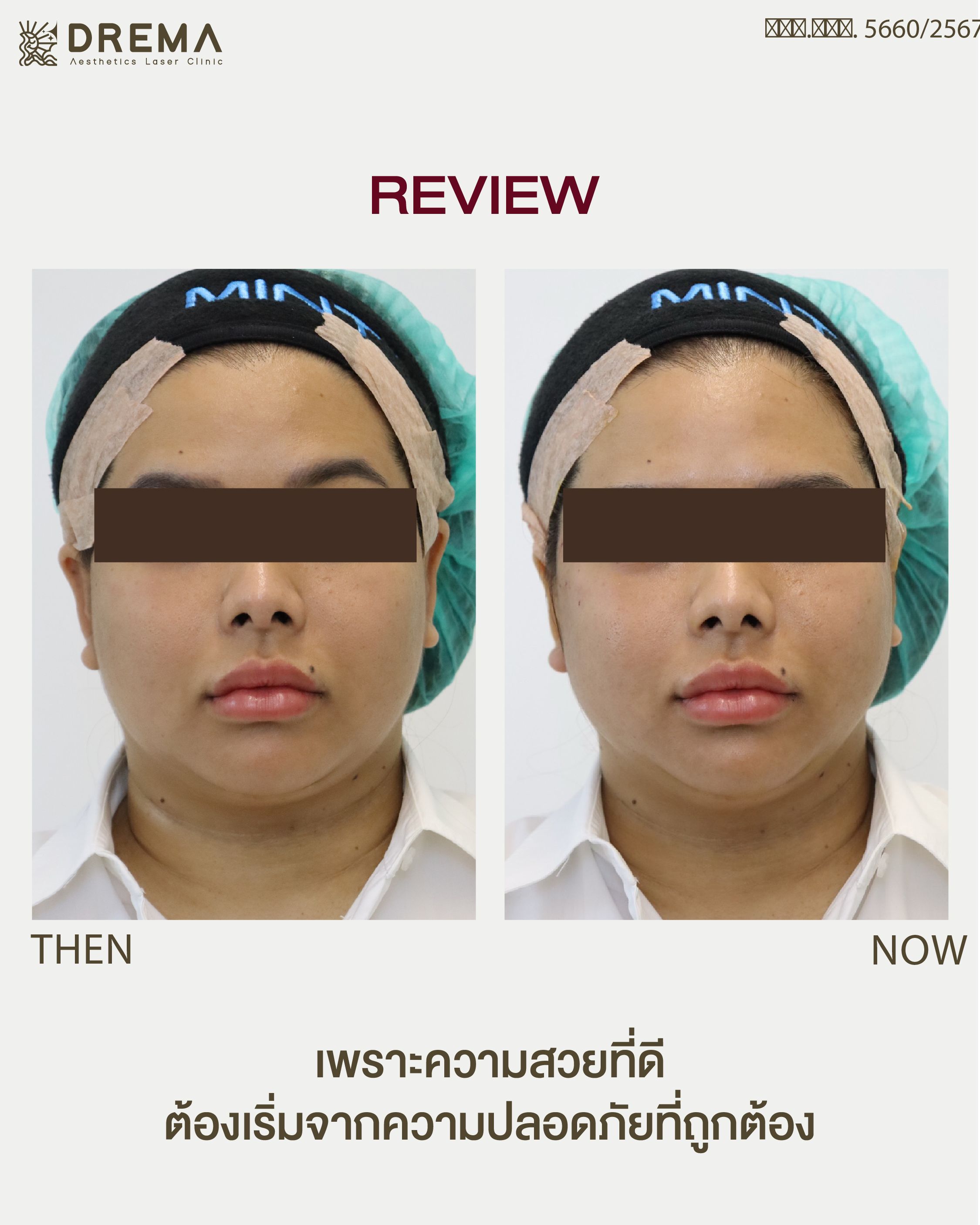 ร้อยไหมหน้าเรียว