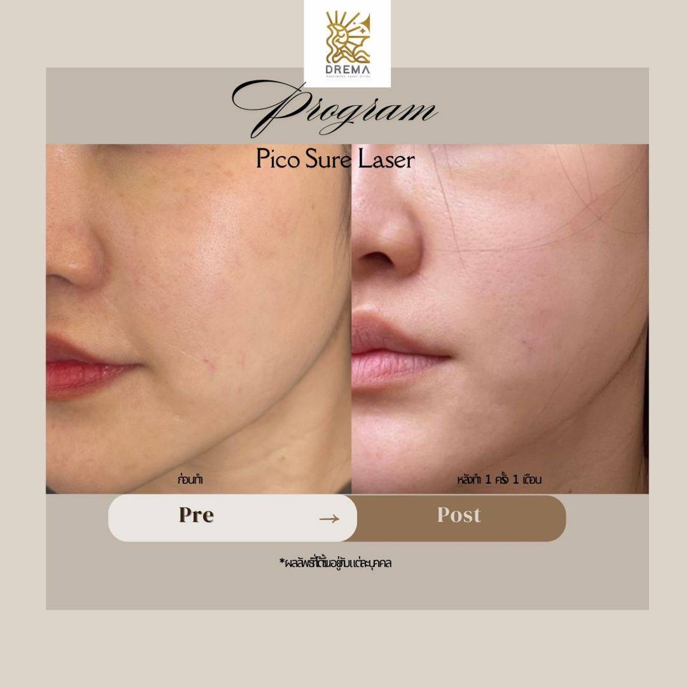 รูปรีวิว Pico Drema Clinic เคสที่ 24