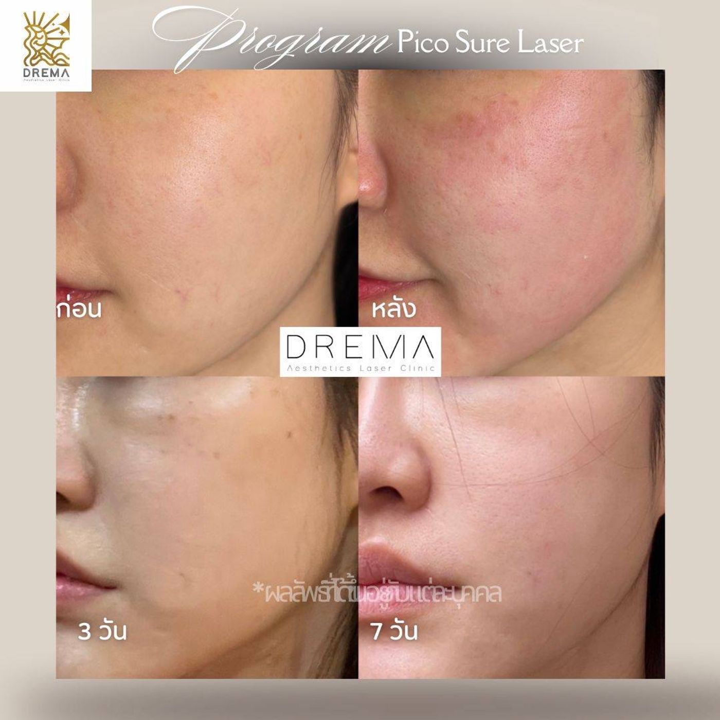 รูปรีวิว Pico Drema Clinic เคสที่ 12