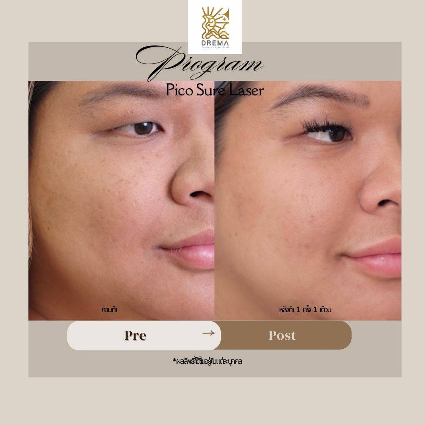 รูปรีวิว Pico Drema Clinic เคสที่ 22